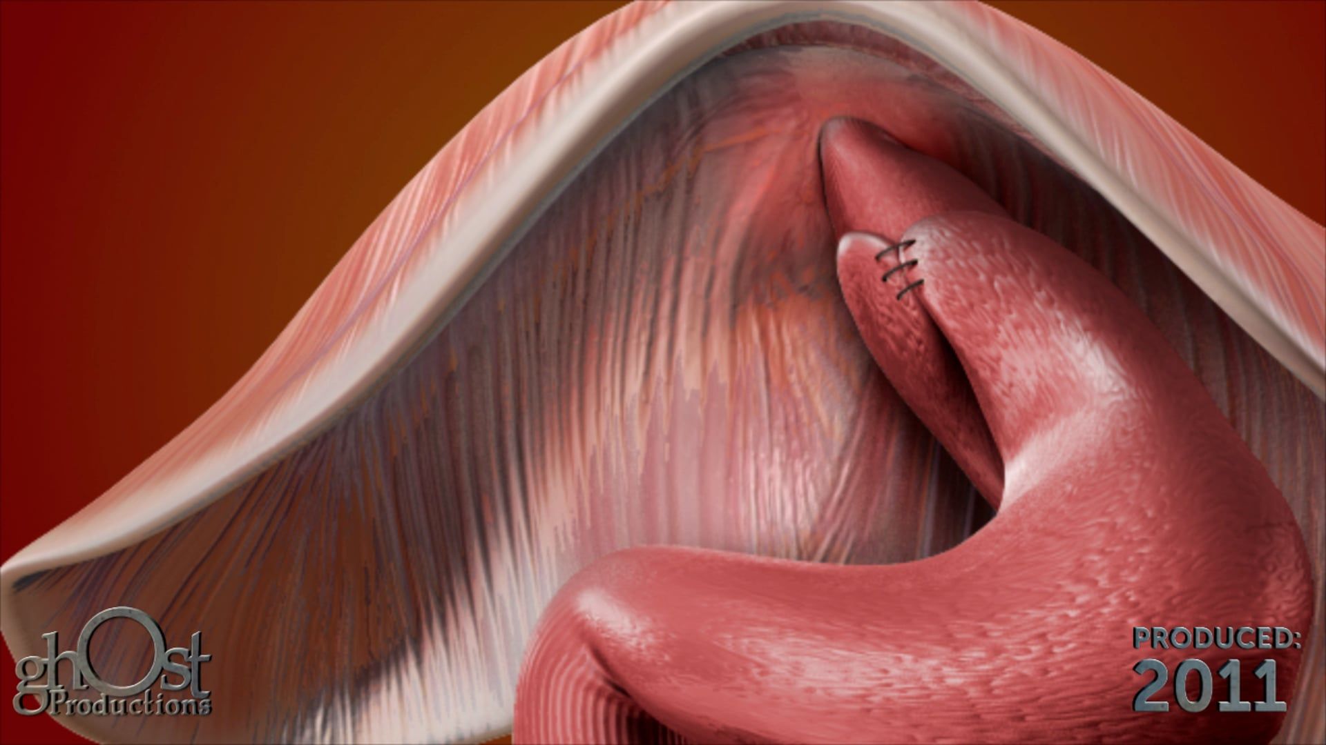 Ghost Medical Presents: Mayo Clinic Fundoplication