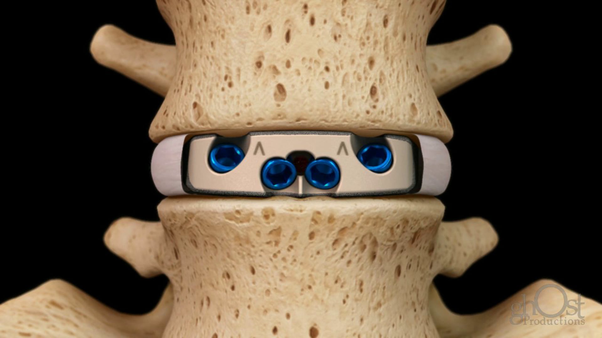 Aesculap, Ghost Productions, medical device company, Arcadius Stand-Alone Interbody Device, spinal fusion surgeries, improved stability, reduced risk of complications, implantation process, self-locking mechanism, customizable sizing options, healthcare professionals, patients, benefits, spinal surgery.