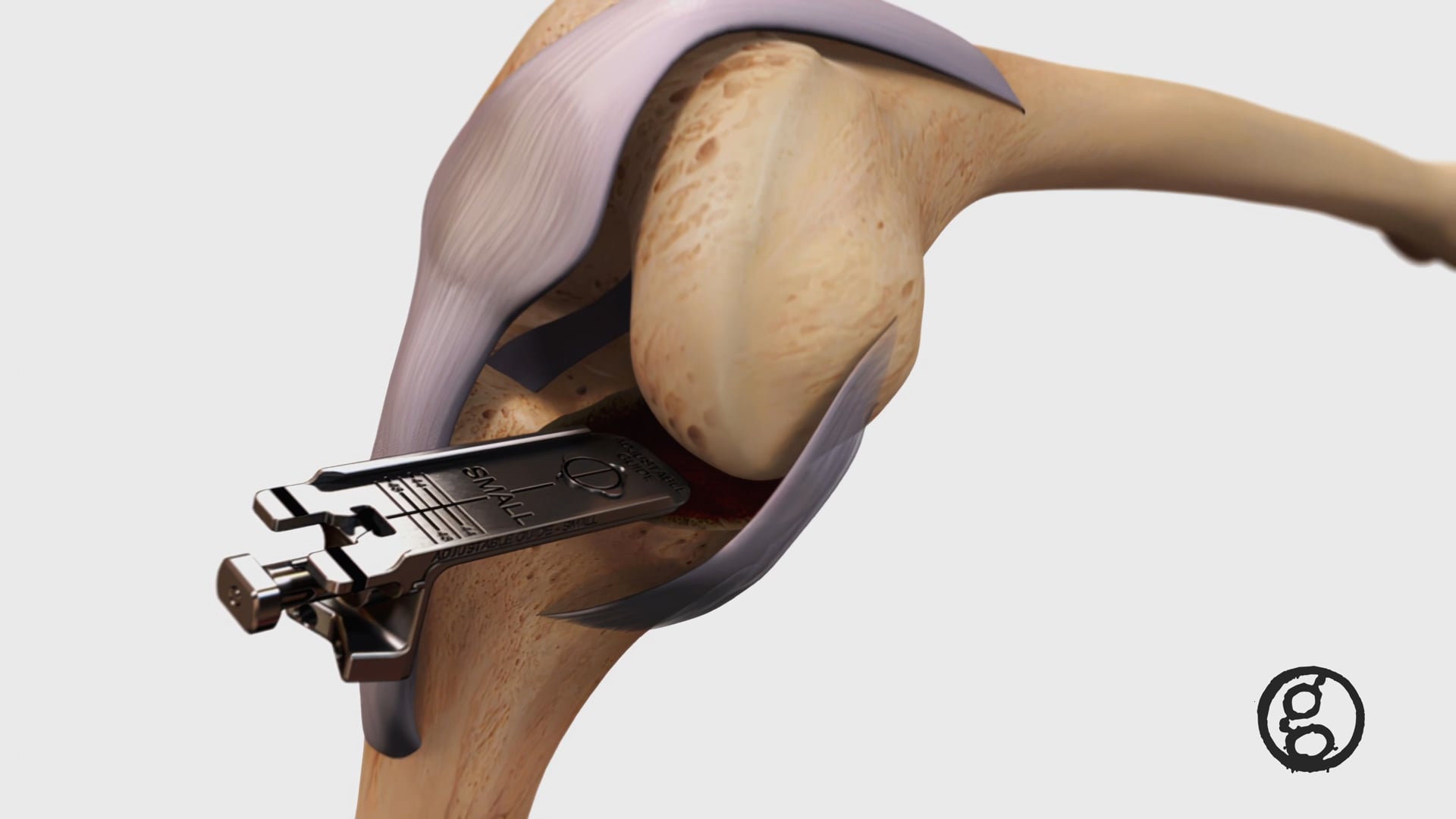 Mirror Knee System, unicondylar knee replacement, patient's own joint ligaments, implant placement, surgical technique, femoral component, tibial tray, bearing component, Ghost Productions, Medical Animation Studio, Surgical VR Developer, medical marketing tools, innovative product, advanced medical technology.