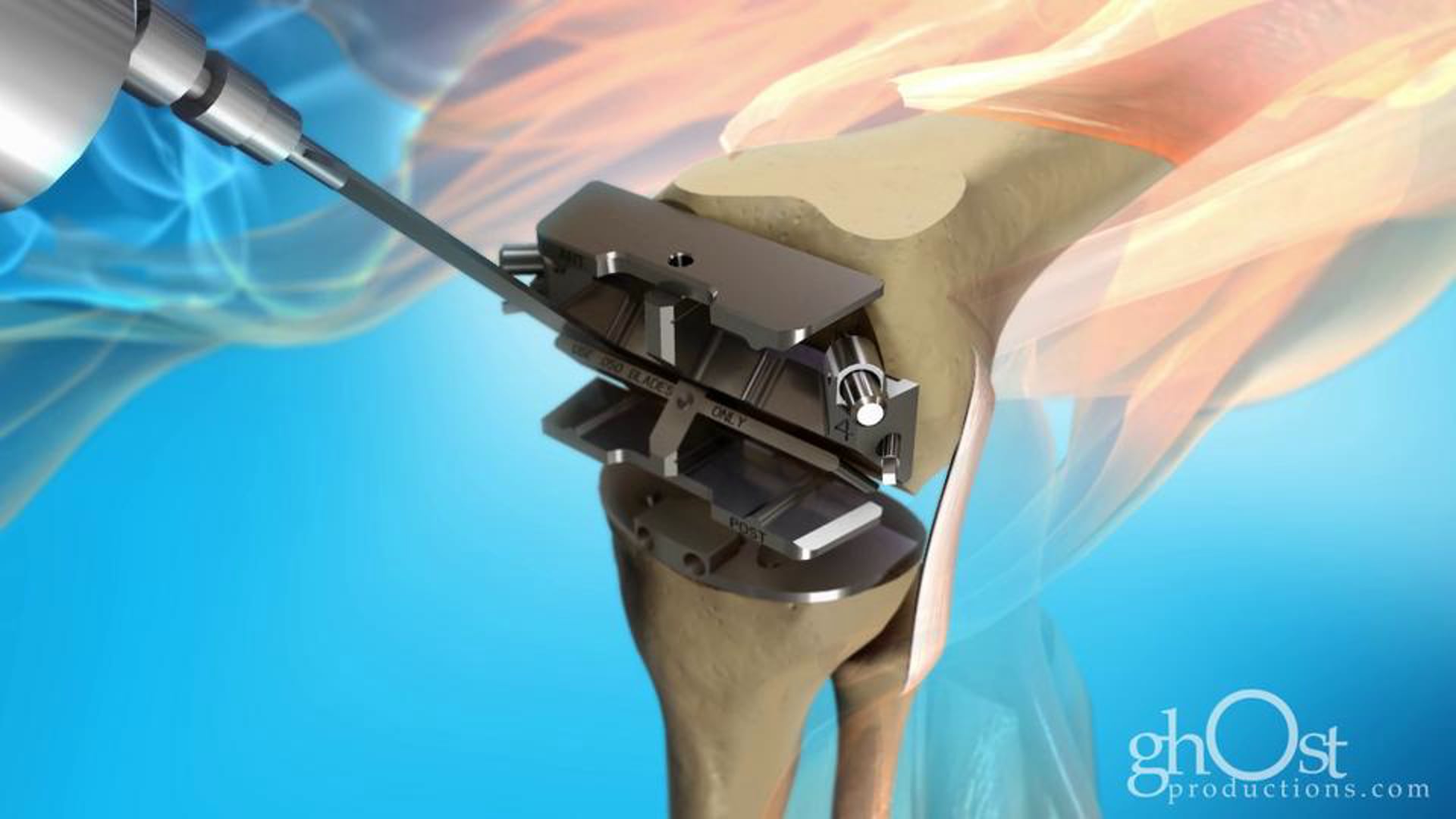 Ghost Medical - Stryker - Patella Balancer Animation