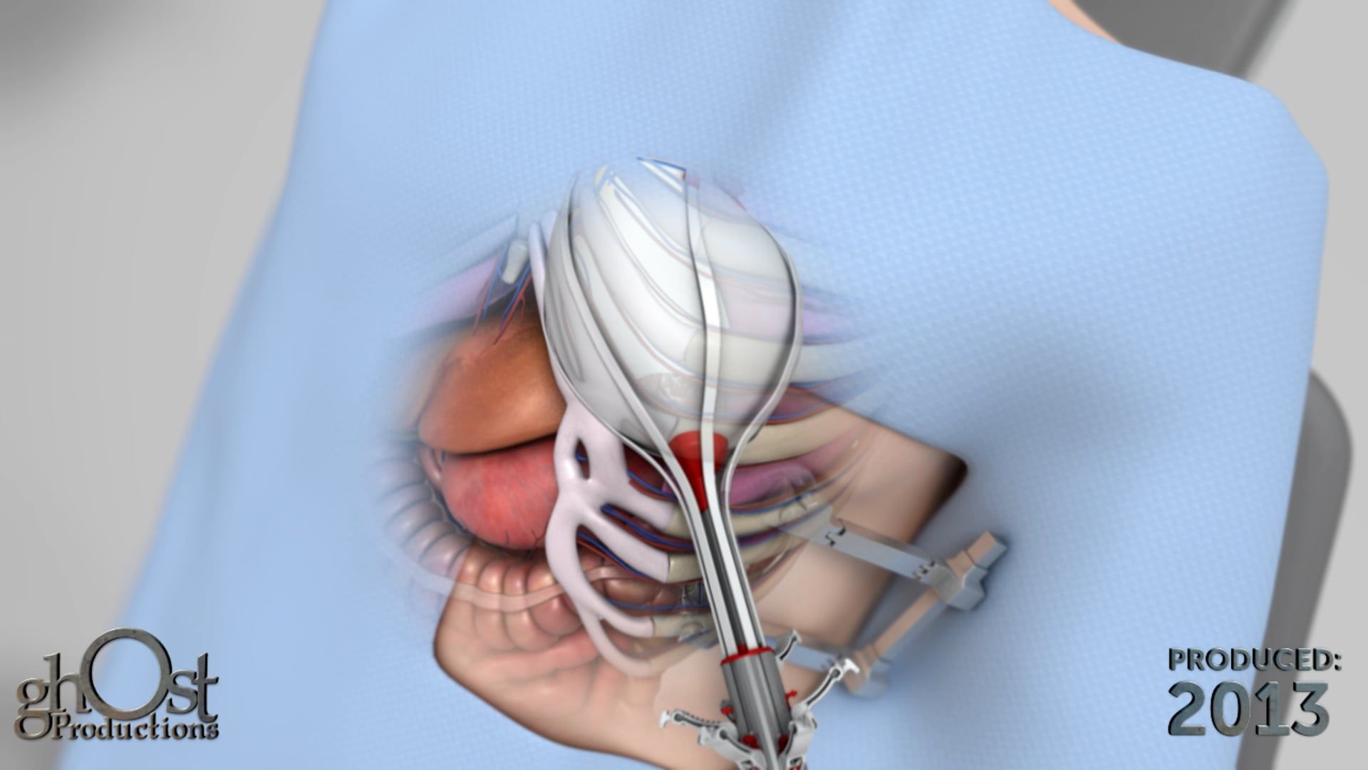 Mardil Medical, Ghost Productions, surgical technique animation, VenTouch device, triad targeted ventricular reshaping system, Type IIIb Functional Mitral Valve Regurgitation, intricate details, unique features, effectiveness, medical professionals, patients, advancing cardiology.