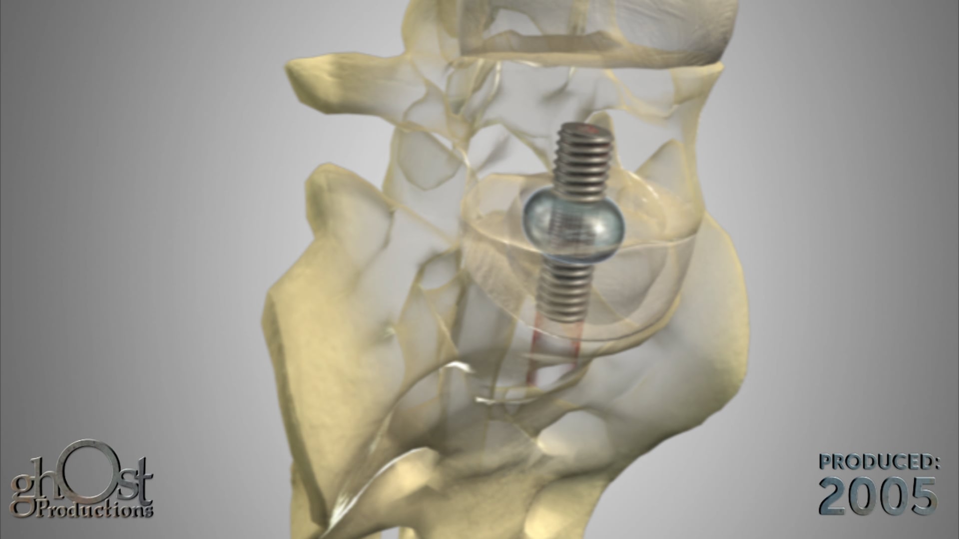 Ghost Medical Presents: TranS1 PNR/PDR Animation
