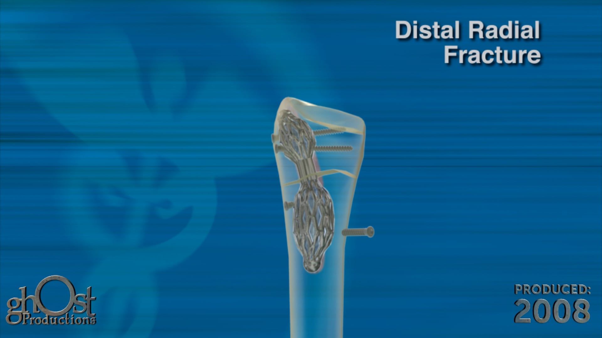Ghost Medical Presents: Treating a Stout Radial Fracture