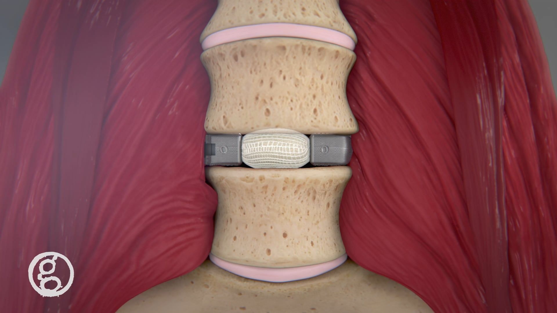 Spine Surgery with Duo™ Ti Expandable Interbody Fusion System, from Ghost Medical