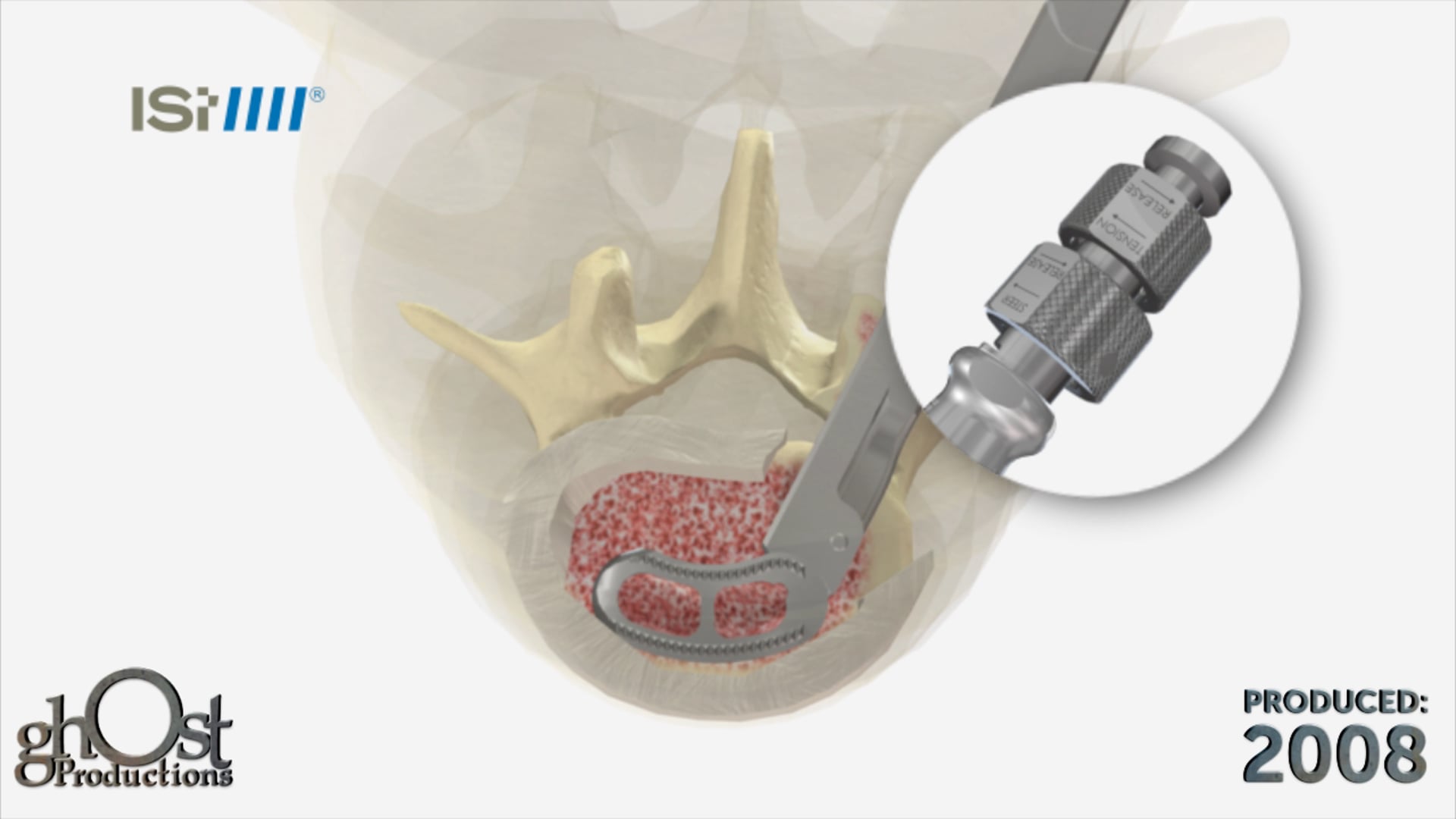 Spinal Technology, Ghost Productions, Axient device, spinal fusion, motion preservation, range of motion, biomechanics chart, superior performance, cutting-edge technology, game-changer, spinal surgery, quality of life, medical animation, medical device.