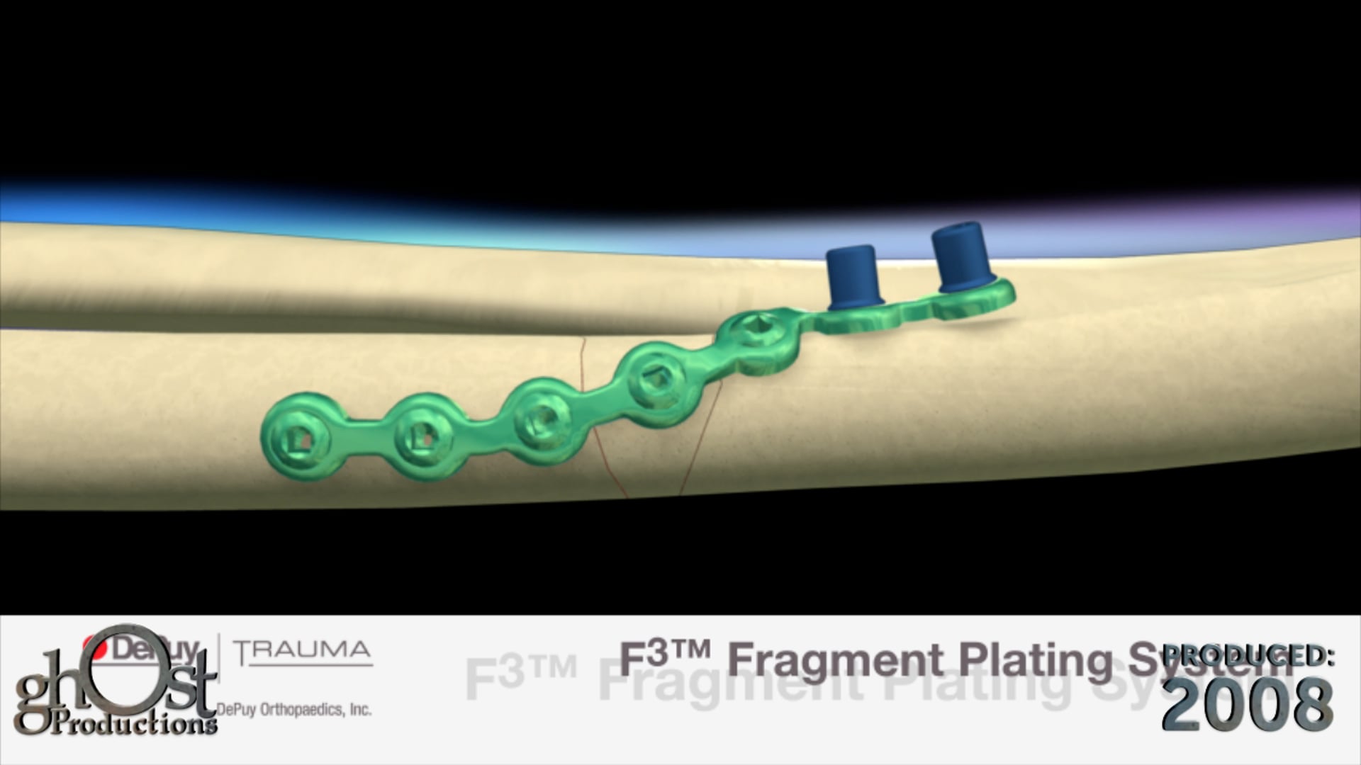 Depuy Trauma, Ghost Productions, surgical technique animation, F3 fragment plating system, segmental fractures, non load-bearing bones, in situ contouring, medical professionals, orthopedic surgery.