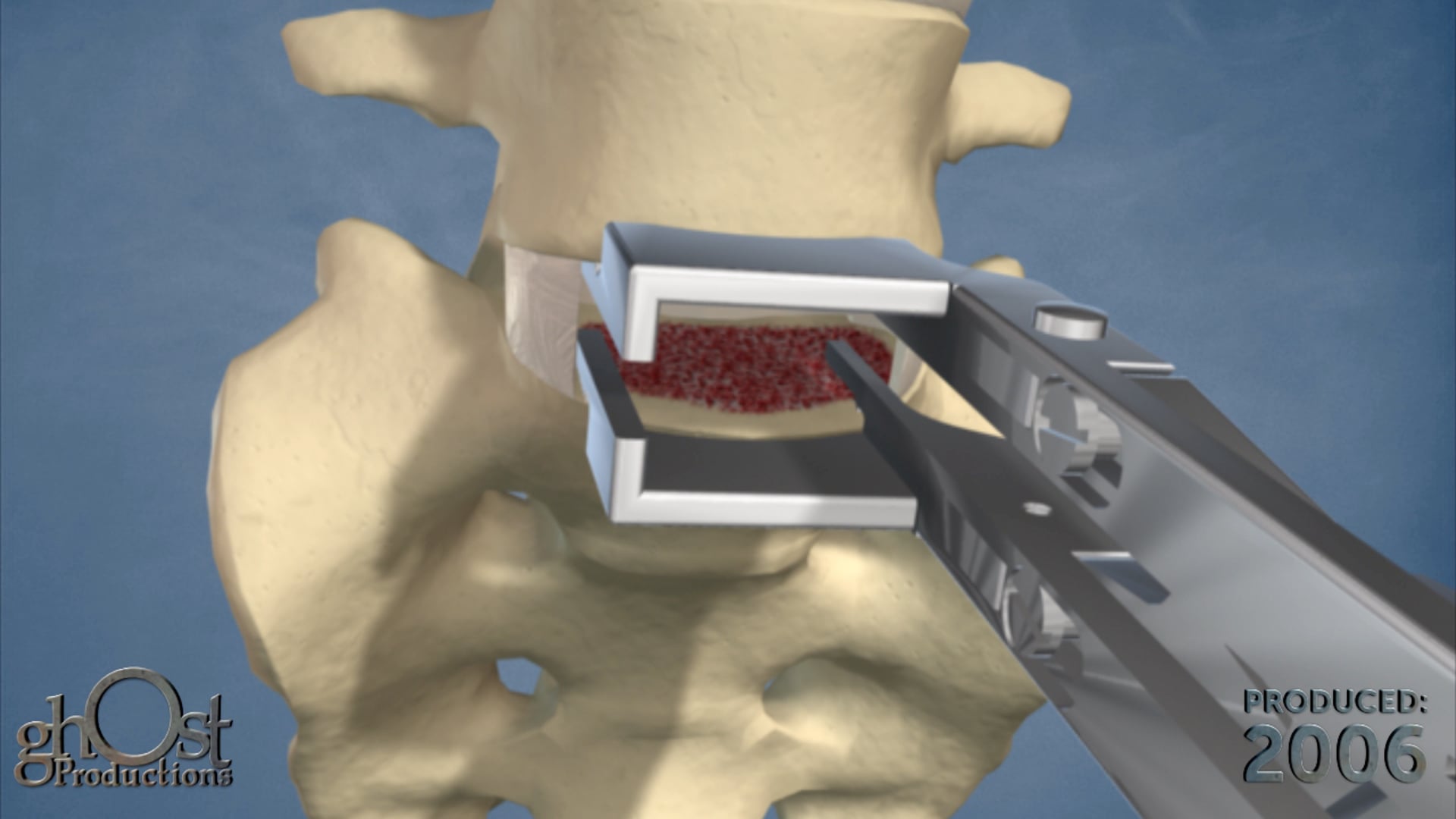 AbbottSpine Harmony, minimally invasive posterior spinal surgery, implantation process, vertebral column, precision, ease, surgical technique, medical product, animation, step-by-step guide, innovative, valuable resource, medical professionals, knowledge, SEO, informative.