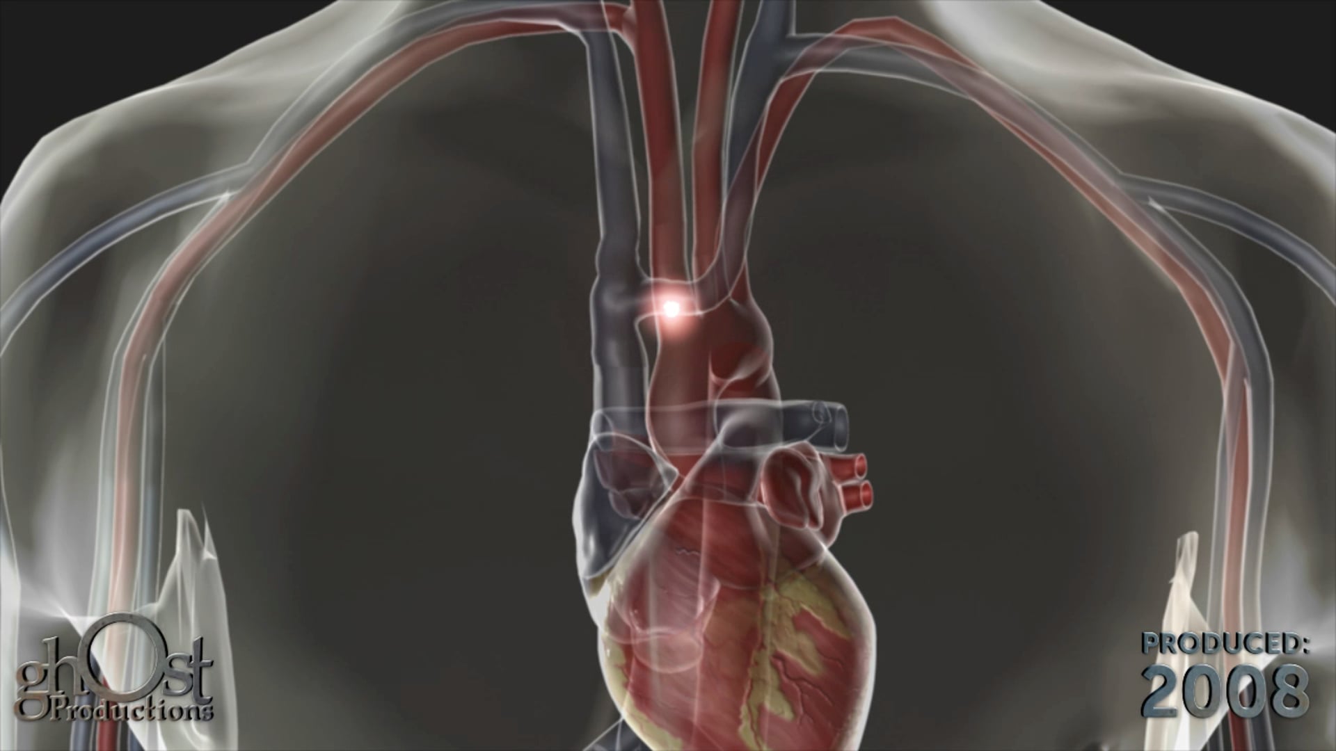 Ghost Productions, medical animation, embolism, circulatory system, medical accuracy, visual stunning, blood vessels, body, medical professionals, patients, early detection, treatment, cardiology, product, diagnose, attention to detail, critical area of medicine, valuable resource, complexities.