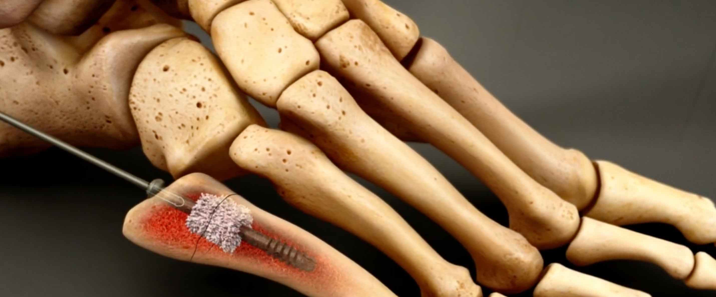 MISSION: Provide Orthogen with a series of short promotional animations of the FlowFX cannulated screw systems for AAOS.