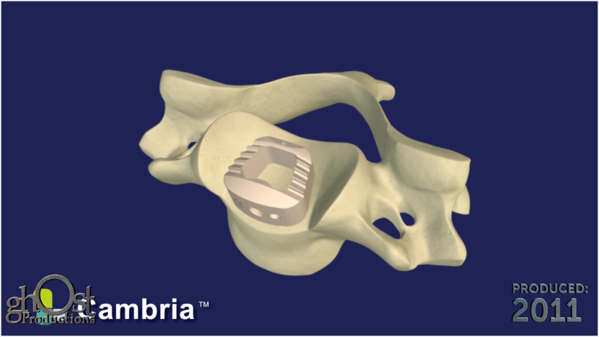 Ghost Medical Presents: SeaSpine Cambria v2