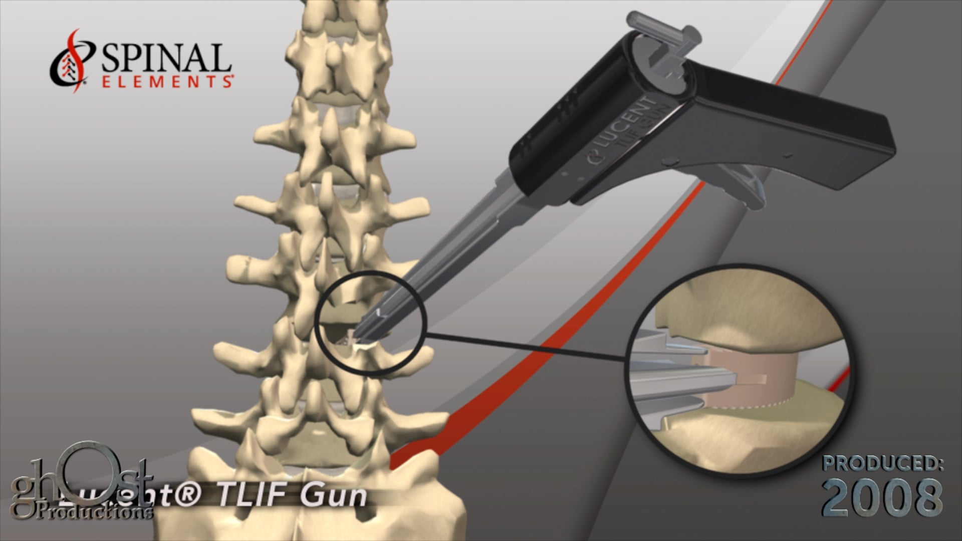 Ghost Medical presents: Spinal Elements TLIF Animation