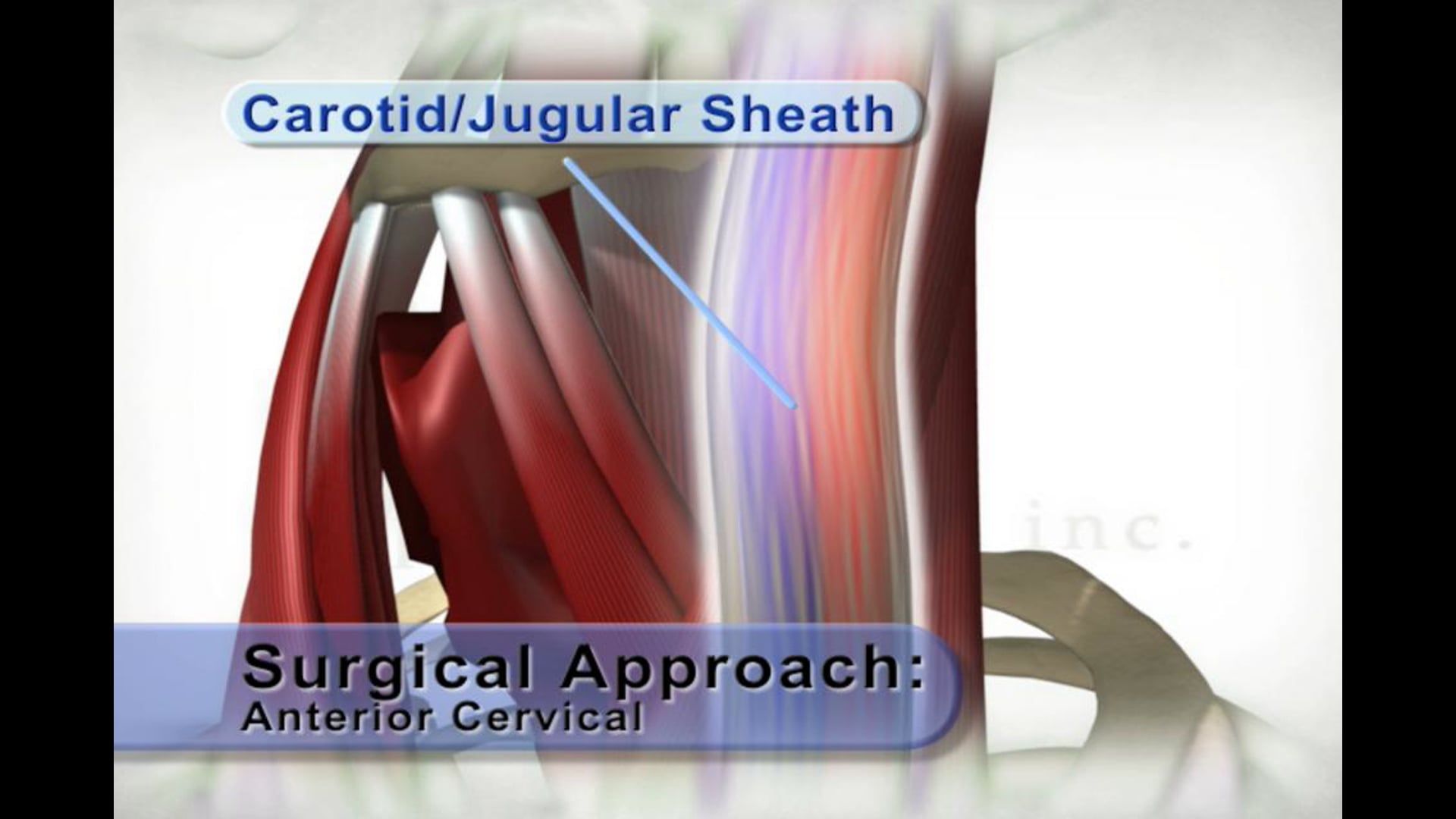 medical animation, anterior cervical surgical approach, neck tissues, sternocleidomastoid, sternohyoid, omohyoid, carotid/jugular sheath, sternothyroid, trachea, longus colli, medical education, medical professionals, medical students, medical resources, Ghost Productions, 2006, .edu websites, .org websites, active link, www.ghostproductions.com.