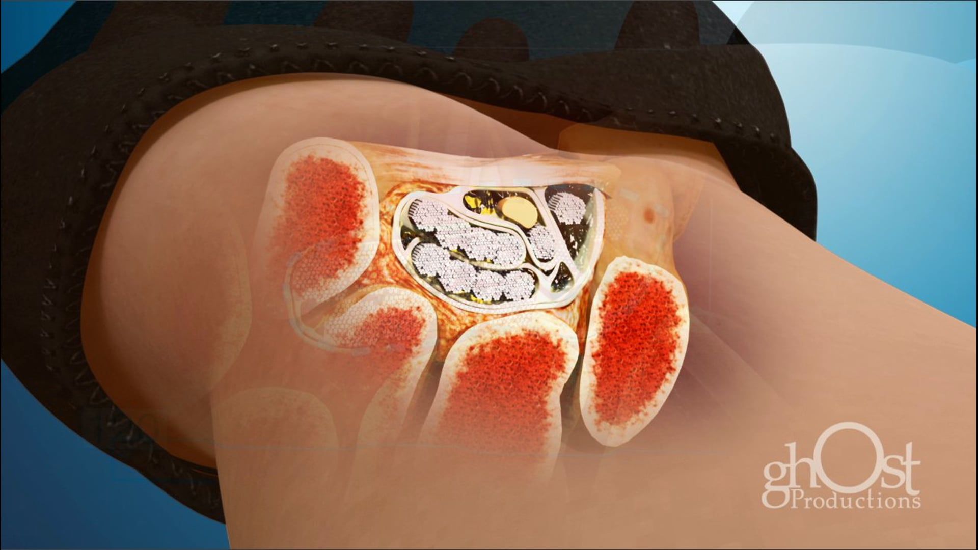 Ghost Medical - IGO - Keo Brace Animation - HD