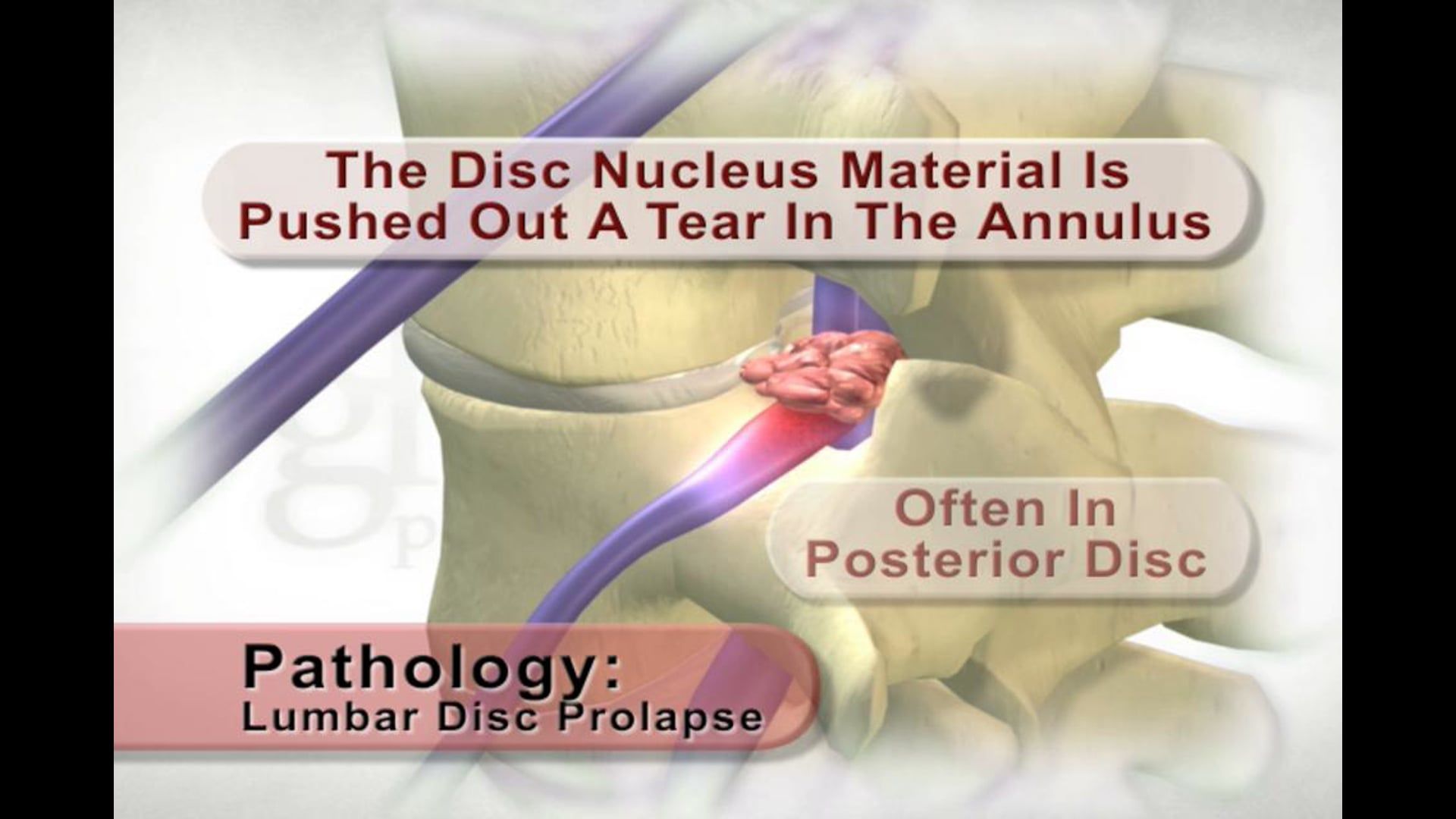 medical animation, spine stress, disc prolapse, disc annulus, nerve root irritation, posterior disc, medical education, medical professionals, Ghost Productions, educational resource, medical video, medical content, SEO, .edu websites, .org websites, active link, medical clients.