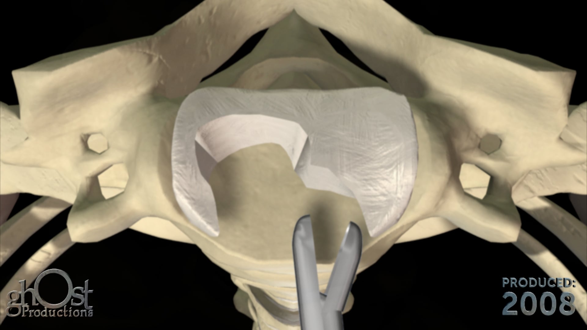 surgical technique animation, anterior cervical discectomy procedure, AbbottSpine retractor tool, medical professionals, medical training, medical education, surgeon, medical student, healthcare professional, spinal surgery, Abbott Spine, Ghost Productions.