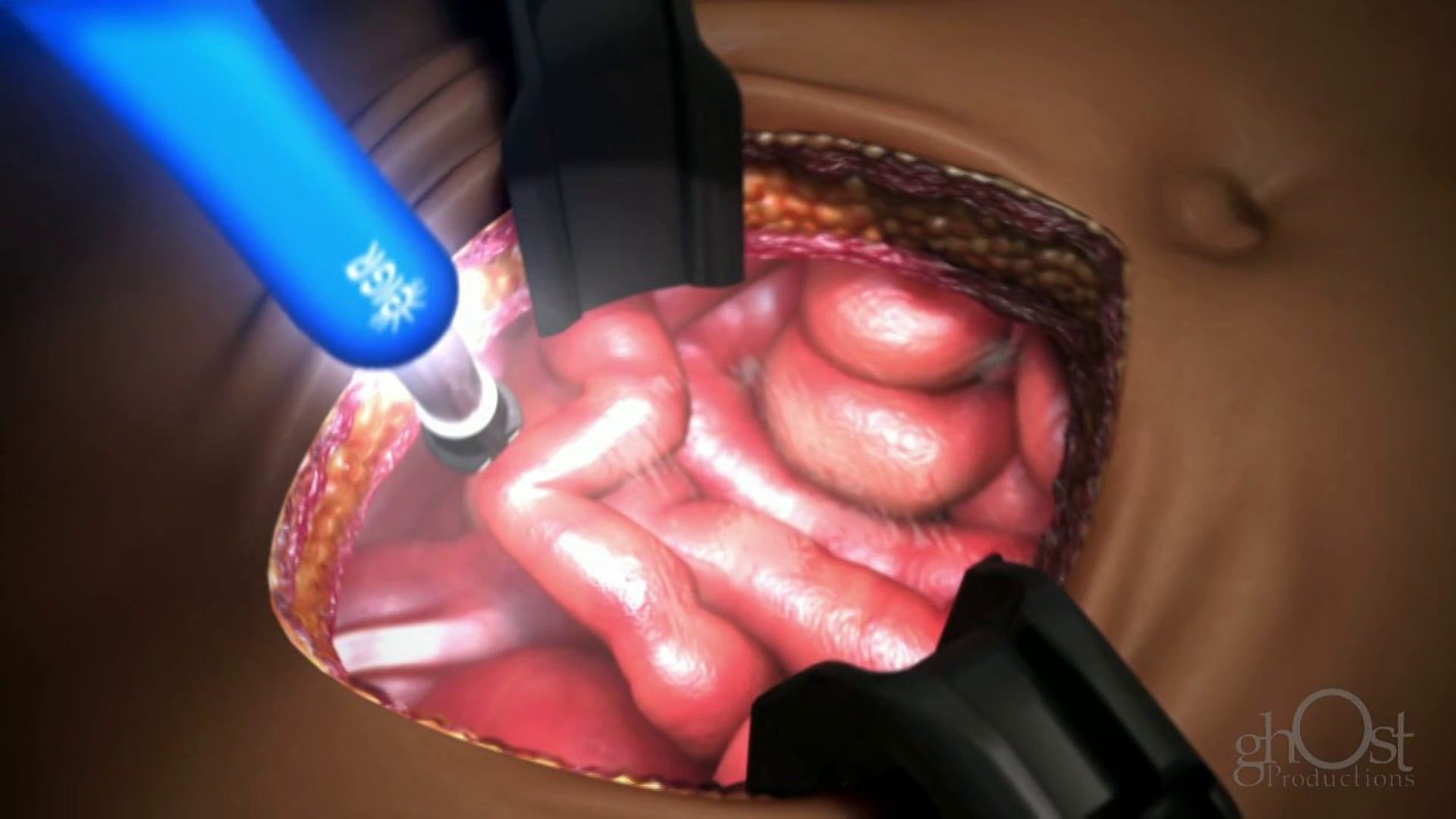 Invuity, Ghost Productions, medical technology, Yankauer device, animated video, James Bond parody, surgery, suction fluids, features, benefits, medically accurate, description, application, medical professionals, education, humor.