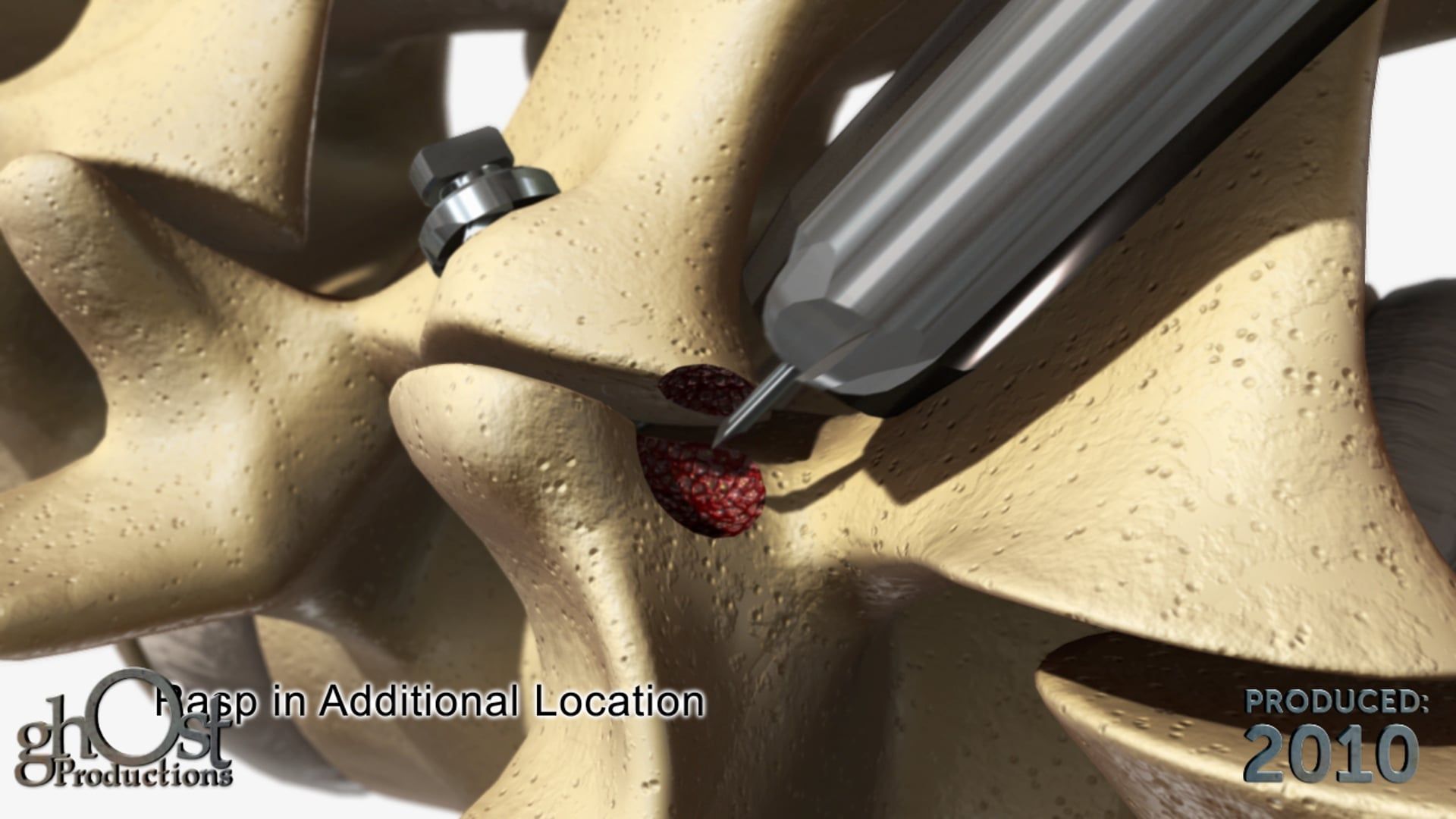Spineology, Ghost Productions, Capture Facet Screw, medical technology, spinal injuries, lower lumbar vertebra, bone graft, spinal conditions, innovative product, animation, medical professionals, patients, technology applications, spinal surgery, search engine optimization, SEO.