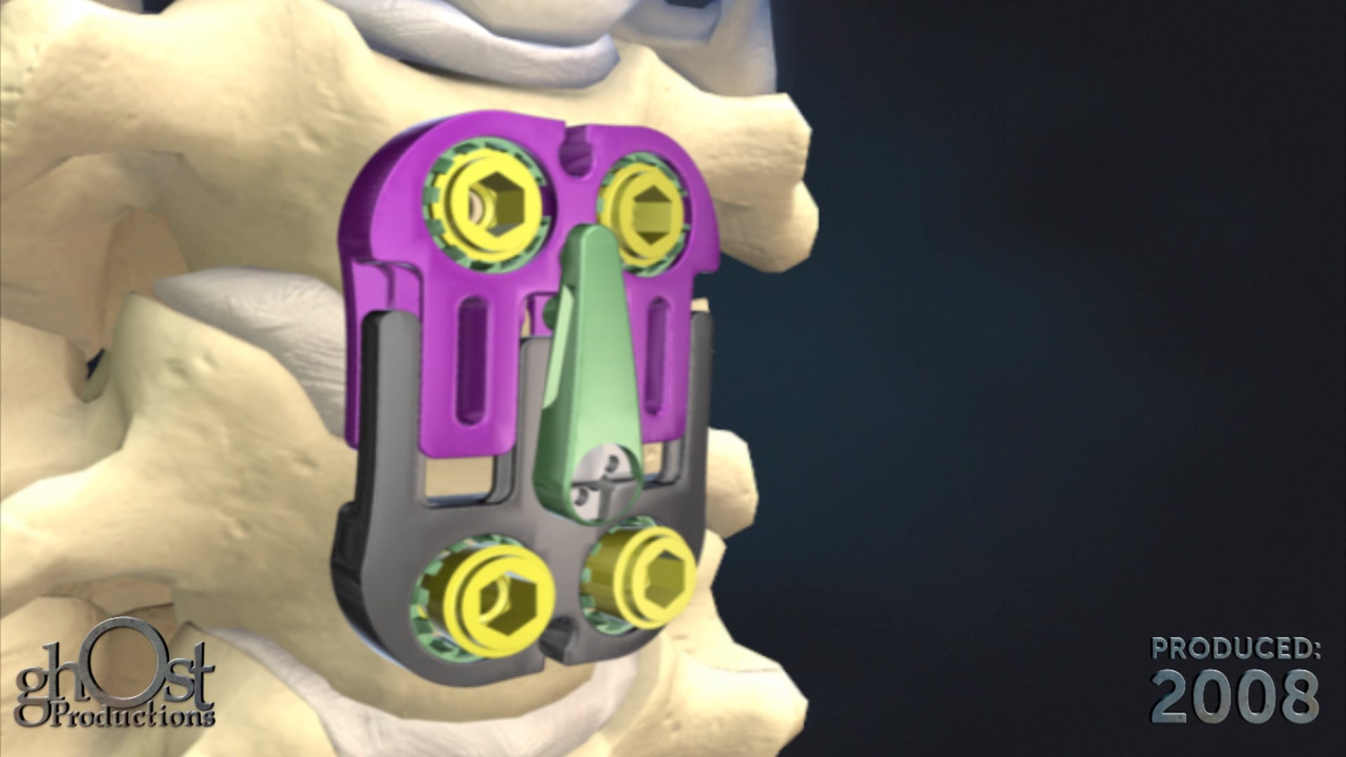 Abbott AntCer PatientEdit with Ghost Medical