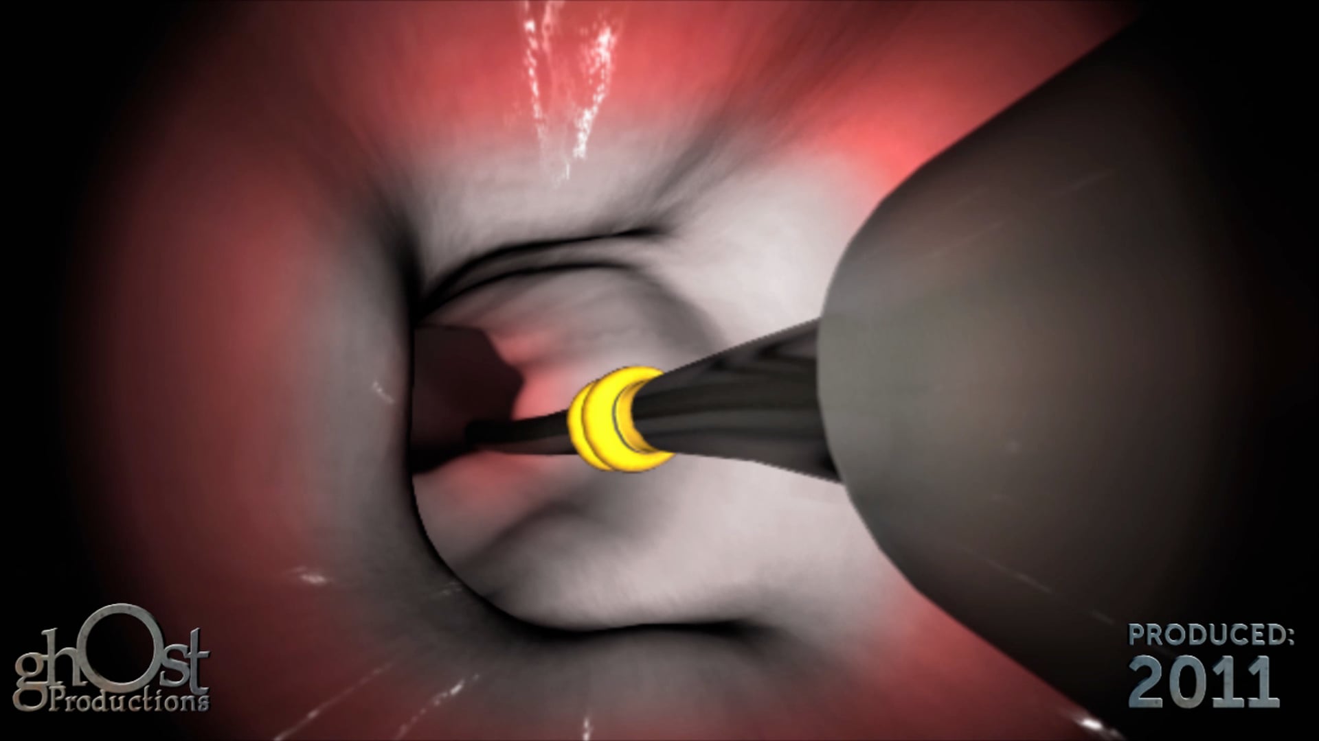 Ghost Medical's Mayo Clinic PhotoAblation: A Revolutionary Treatment for Medical Conditions