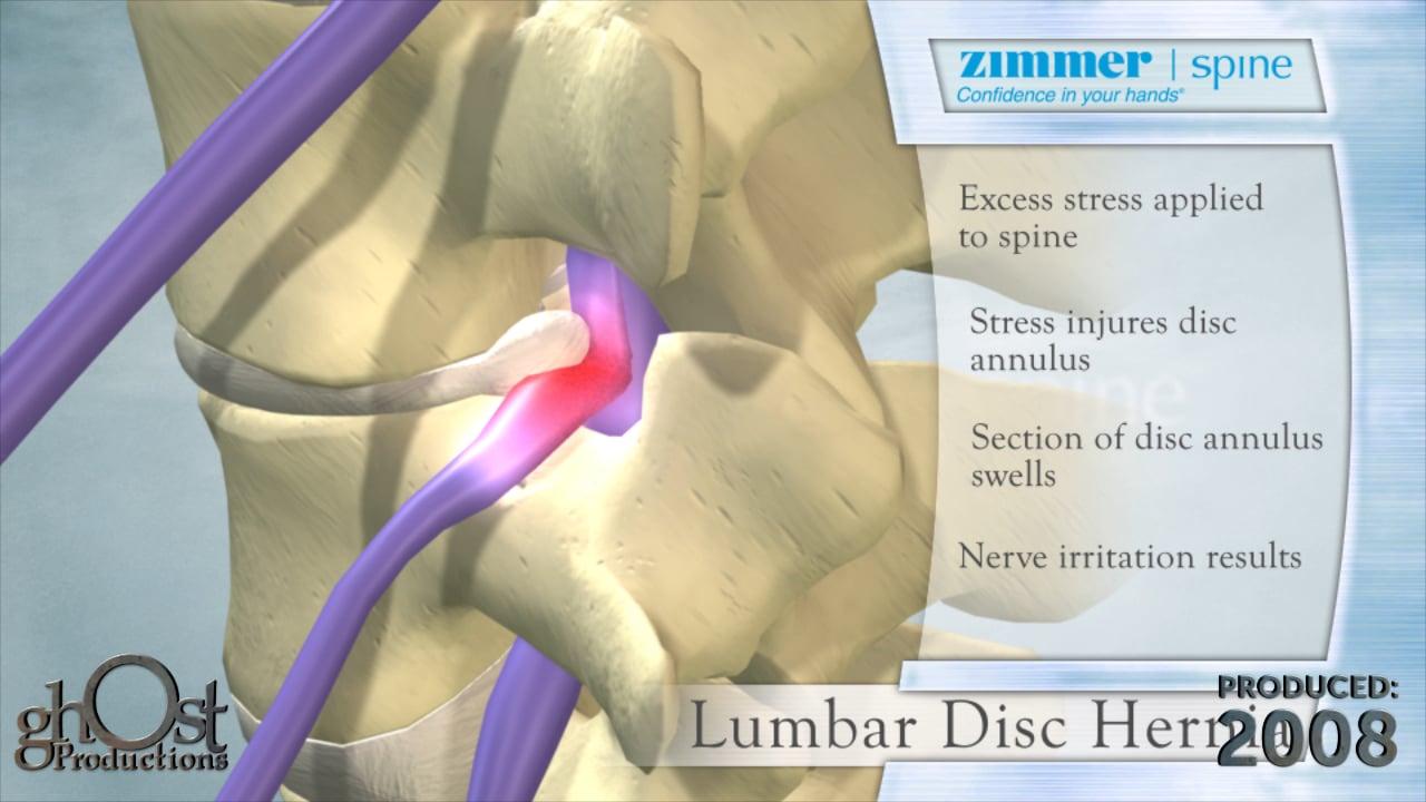Zimmer Spine, Ghost Productions, herniated disc, spine medicine, nerve irritation, associated pain, medical animation, spine details, disc damage, bulging disc, nerve compression, patient education, healthcare professionals, spinal condition, treatment options, innovative medical solutions.