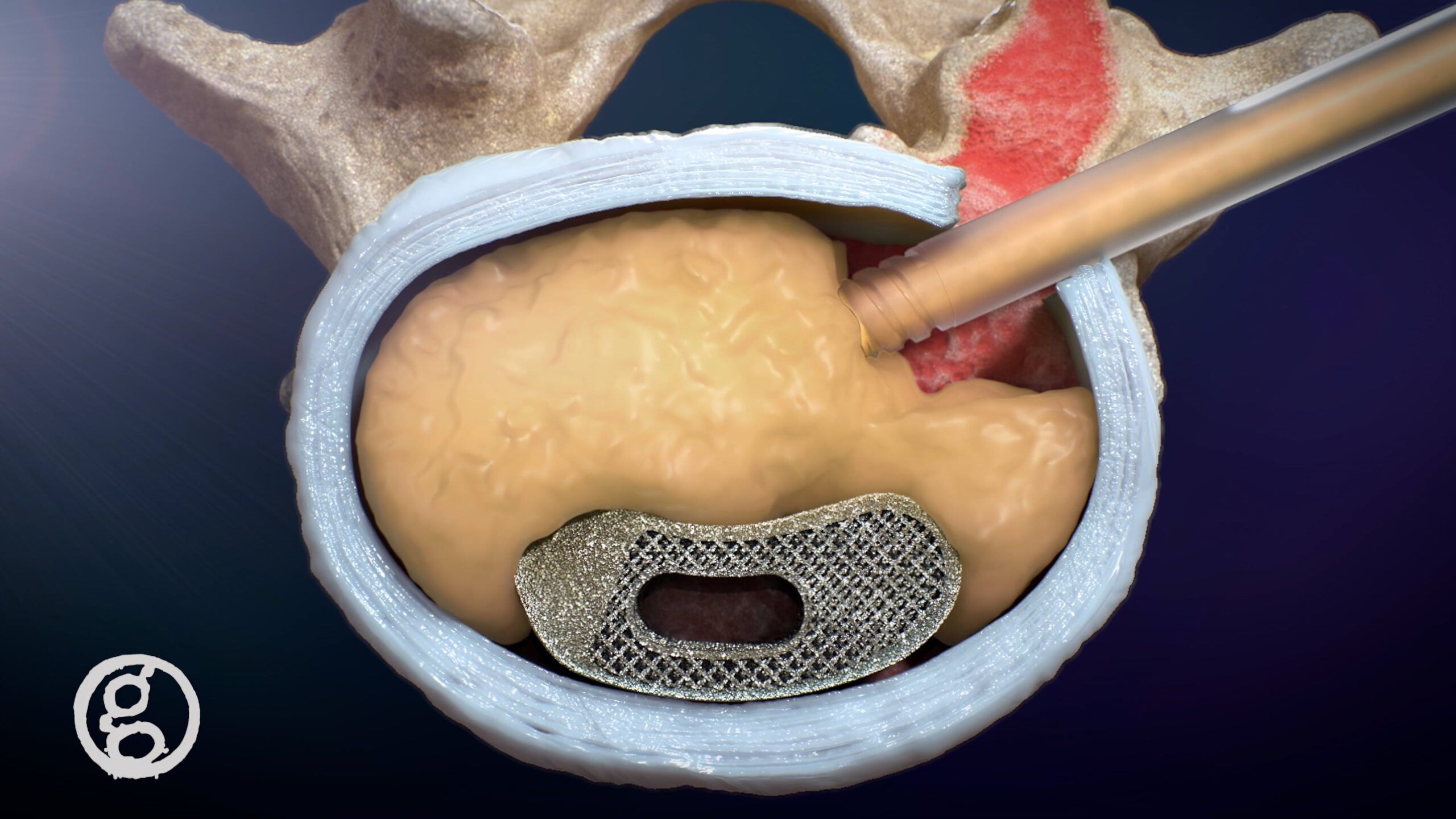 Ghost Productions Medical Device Marketing Demo Reel | Video