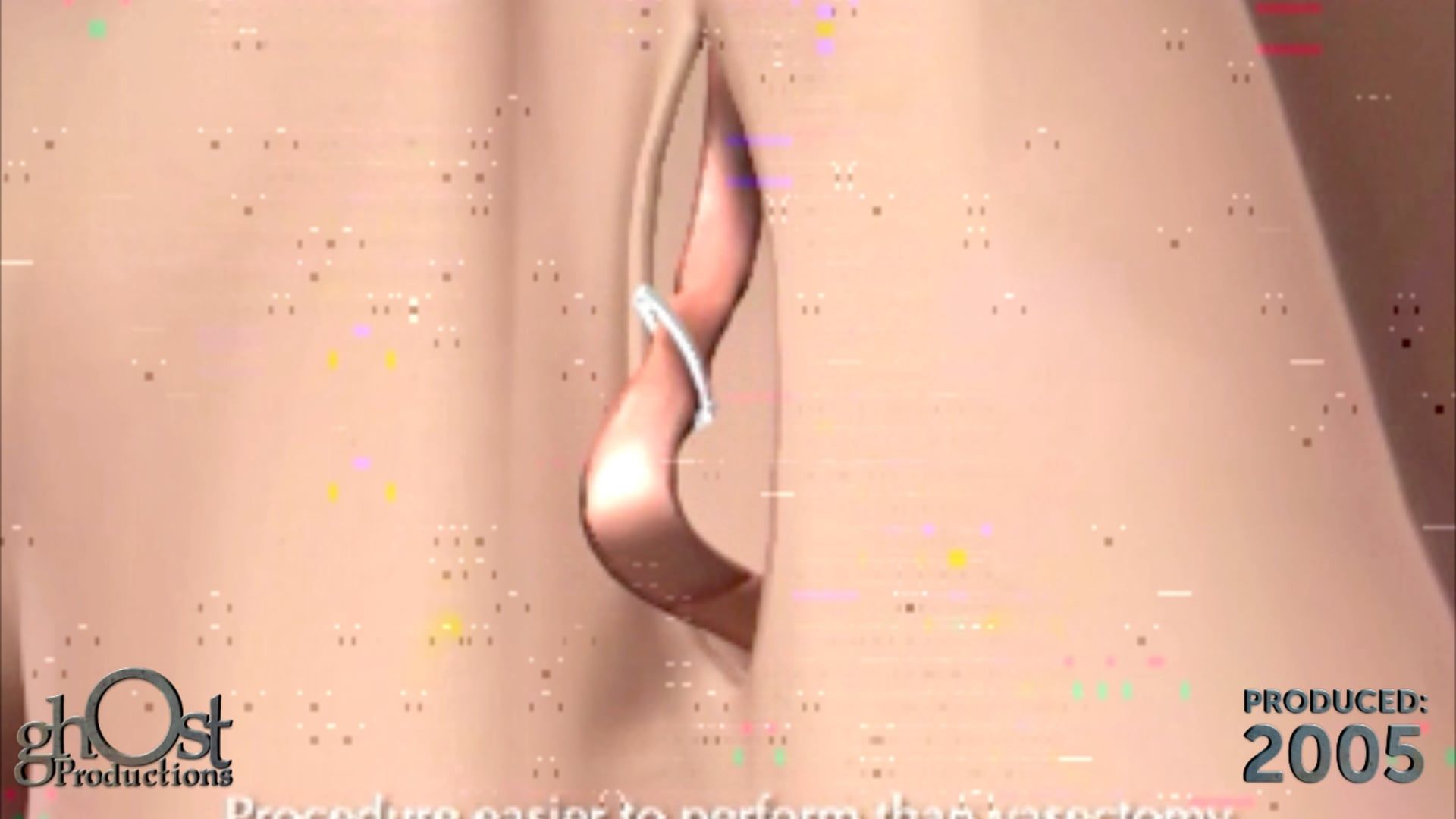 medical animation, Vas-Switch, male contraception device, Ghost Productions, Imagine Medical, wirelessly controlled clip, Vas Deferens, innovative product, greater control, contraception, unique features, benefits, revolutionize, male contraception, medically accurate depiction, healthcare professionals, patients, groundbreaking product.