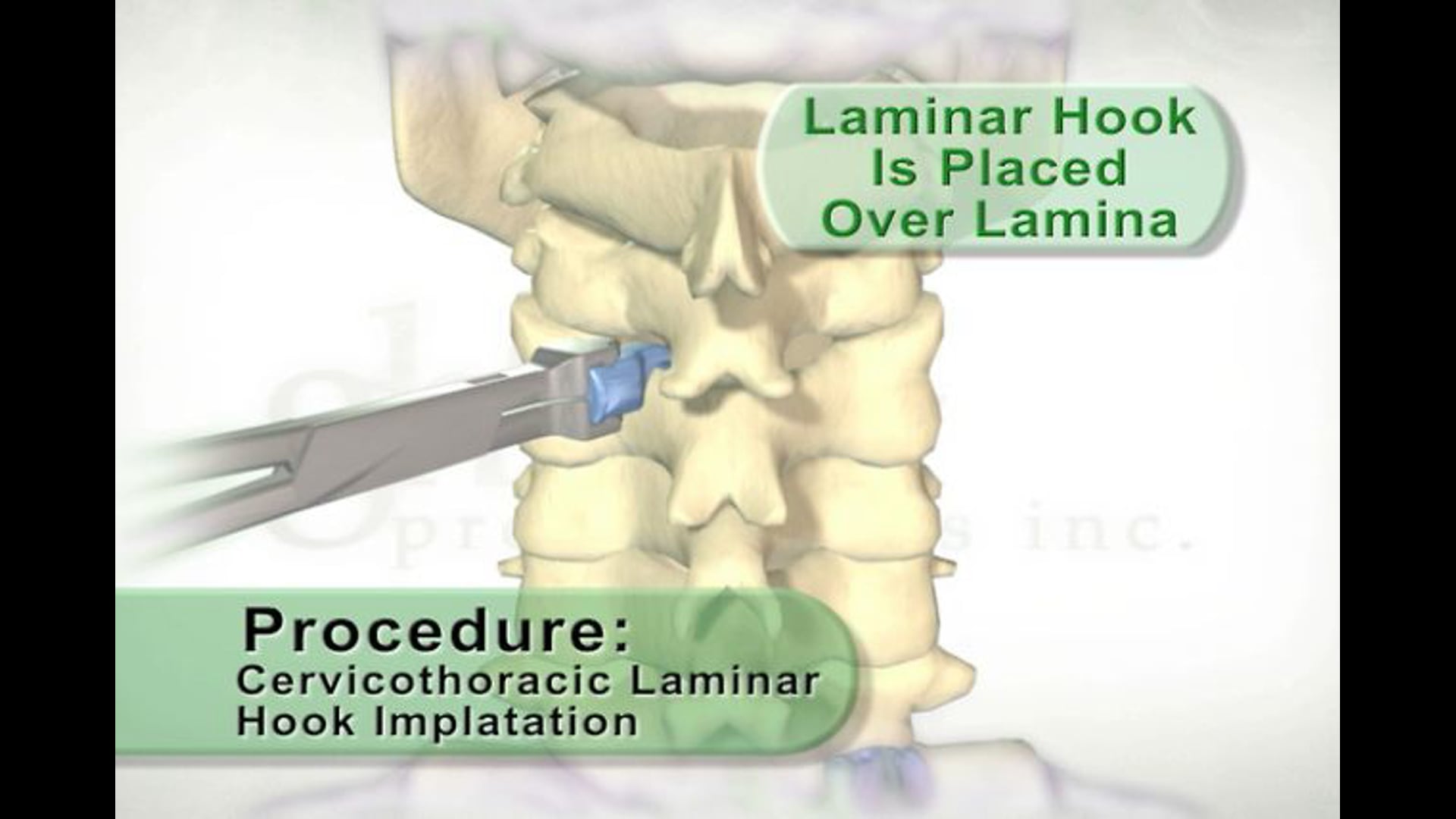 Spinal fixation surgery, pedicle hooks, laminar hooks, support rods, retention screws, cortical bone removal, medical animation, Ghost Productions, educational resource, medical professionals, .edu websites, .org websites, active link, www.ghostproductions.com.