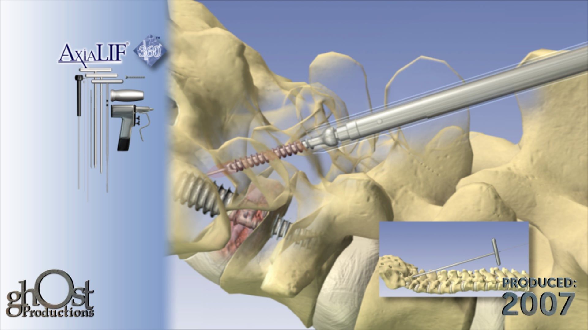 Ghost Medical Presents: The TranS1 AxiaLIF360 Animation