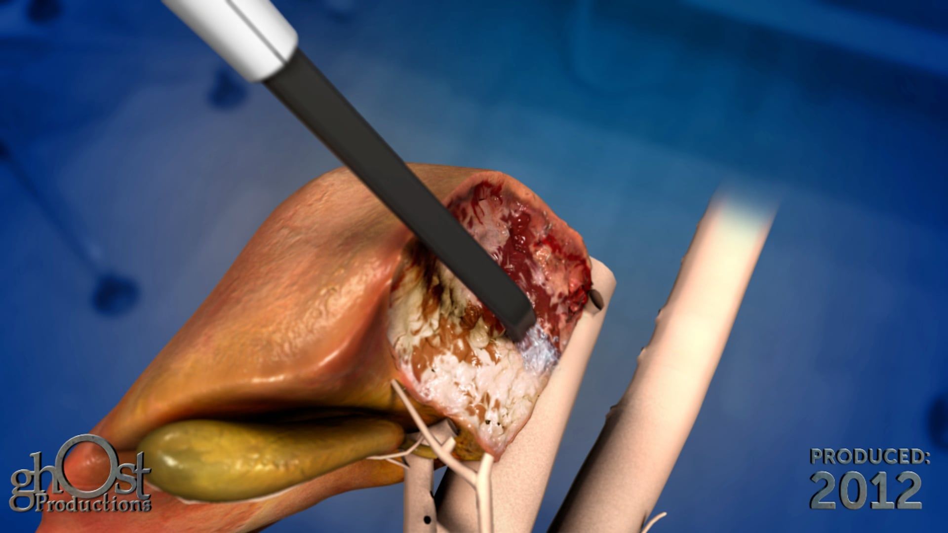 Ghost Medical Presents: Aquamantys Liver Animation