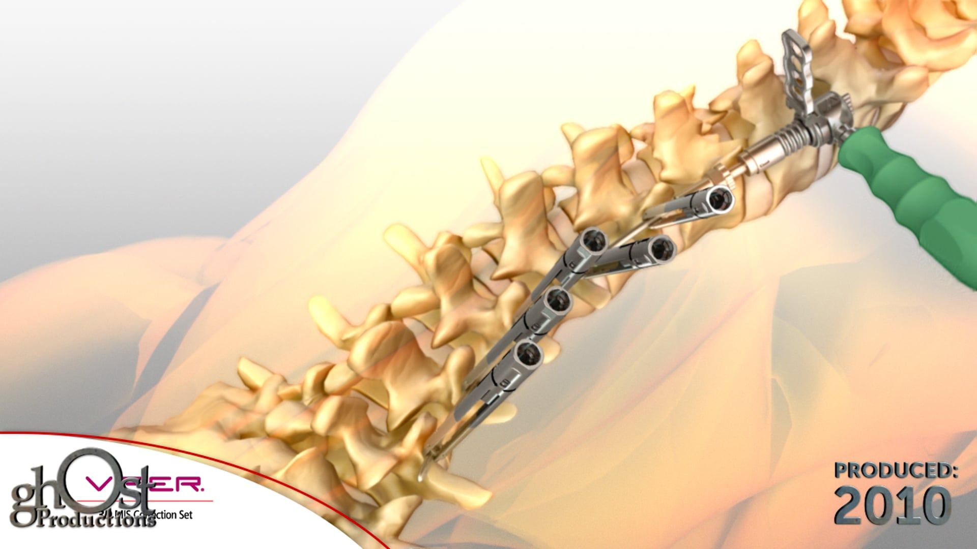 Depuy Viper 3D device, minimally invasive tool, surgeons, thoracolumbar spine, animation, curvature, lumbar region, L1-L5 vertebrae, precision, effectiveness, game-changer, spinal surgery, innovative tool, multiple pathologies, minimal invasiveness, medical community.