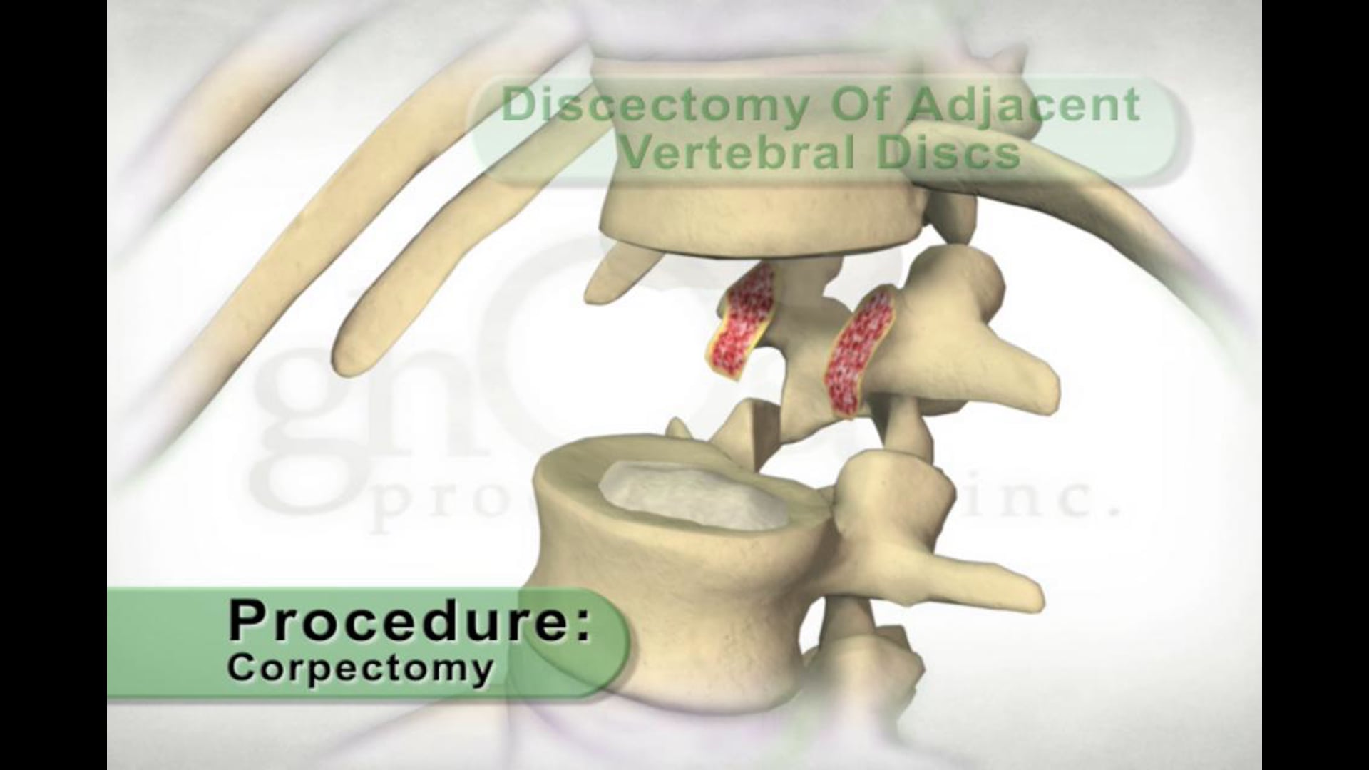 compression fractures, vertebrectomy procedure, vertebrae treatment, medical animation, Ghost Productions, pedicle screw and rod constructs, strut graft, endplates preparation, decompression, medical education, medical professionals, medical students, spine surgery, vertebral discs removal, medical accuracy, medical resource, medical video, medical distribution, medical website, medical SEO