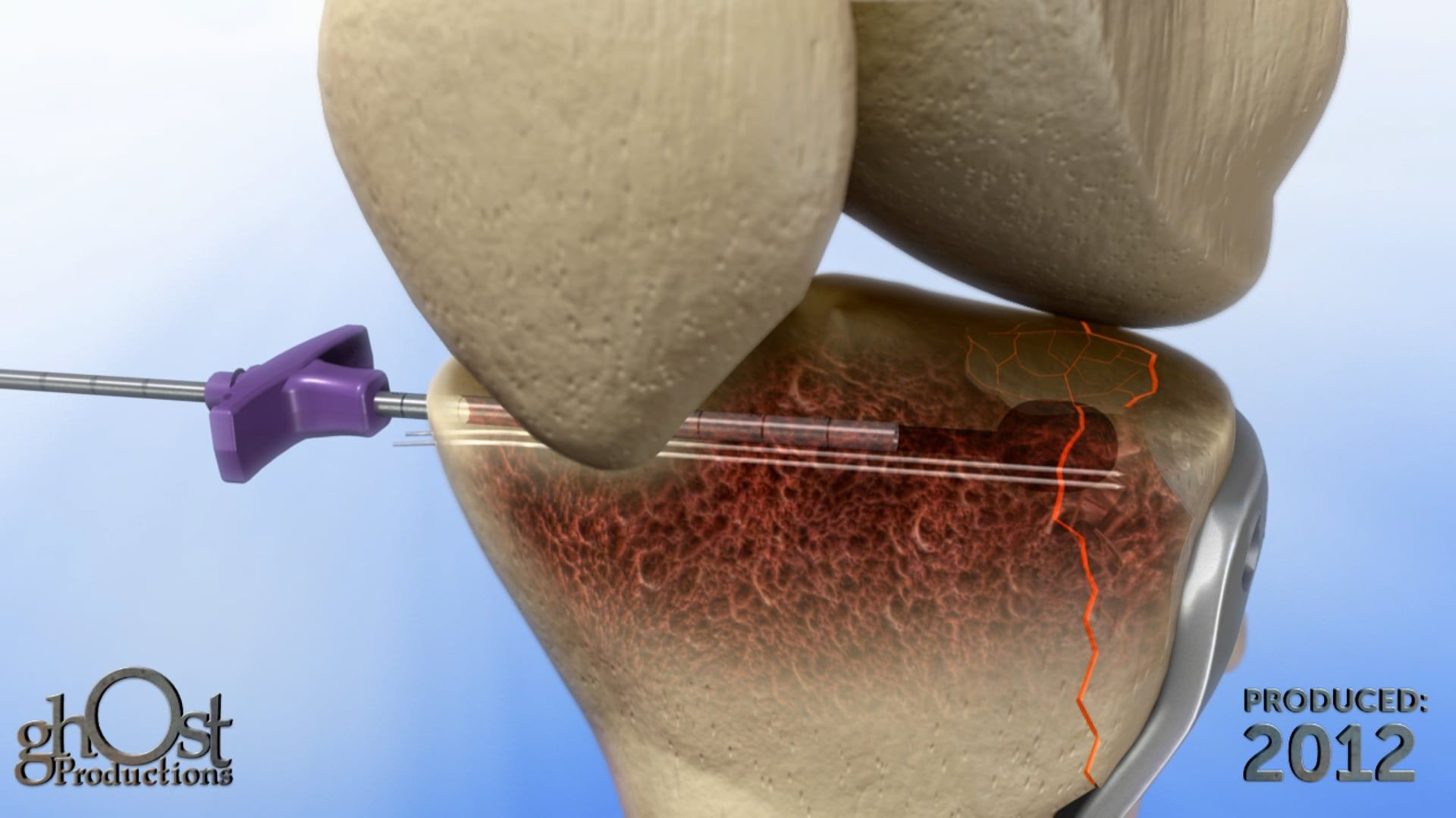 Medtronic, Ghost Productions, tibia plateau fracture, balloon kyphoplasty, plating device, orthopedic medicine, fracture treatment, medical animation, medical technology, innovative solutions.