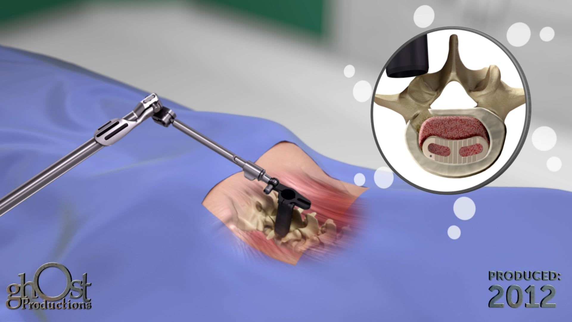 Spineology, Rampart T device, interbody fusion implant, articulation capabilities, Ghost Productions, animation, unique features, cage position, implantation process, flexibility, precision, innovative product, game-changer, spinal surgery, interbody fusion procedures.