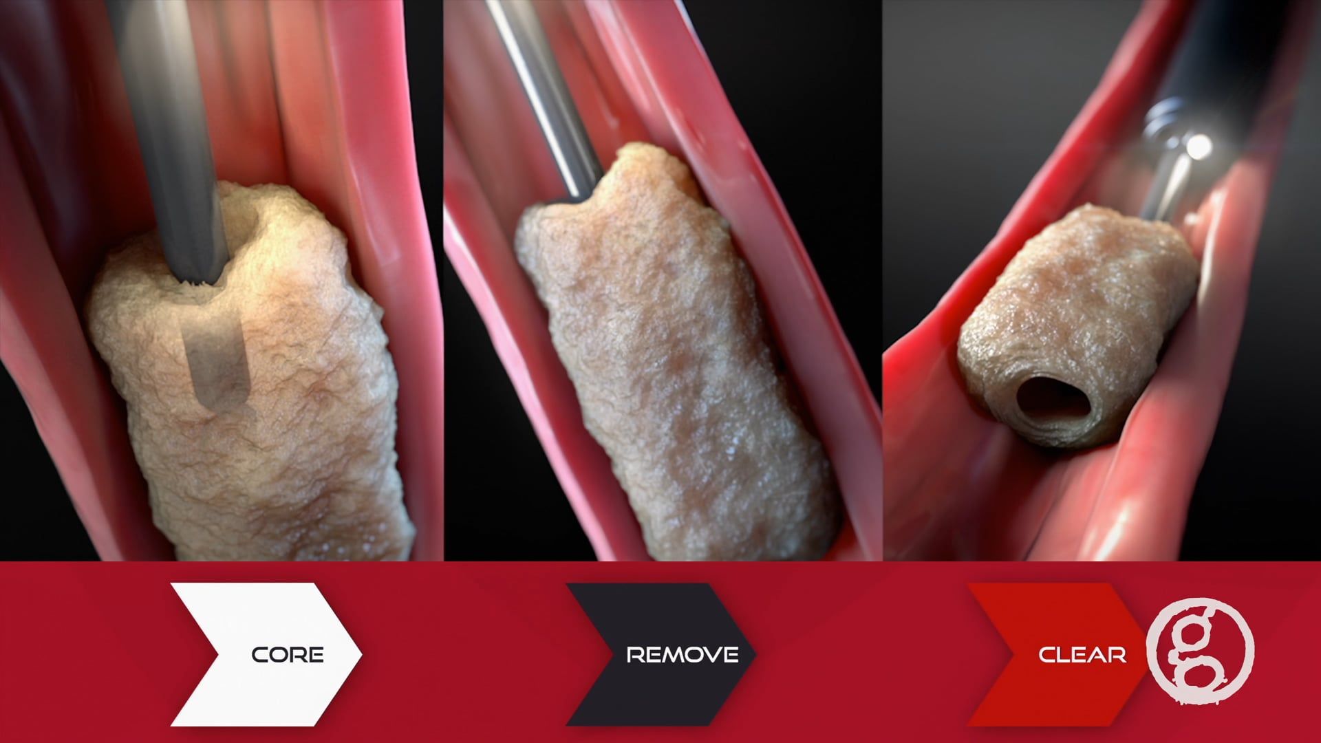 Piranha ER Sheath, Aspiration Catheter, Clinical Luminal Endoscopic Assessment, CLEANS Technique, Esophageal Food Impaction, Ghost Productions, Biomerics, Medical Animation, Piranha GI Aspiration Catheter, Hollowing, Suction, Food Bolus, Spontaneous Food Passage, Medical Devices, Pharmaceutical Products, Surgical VR Developer.