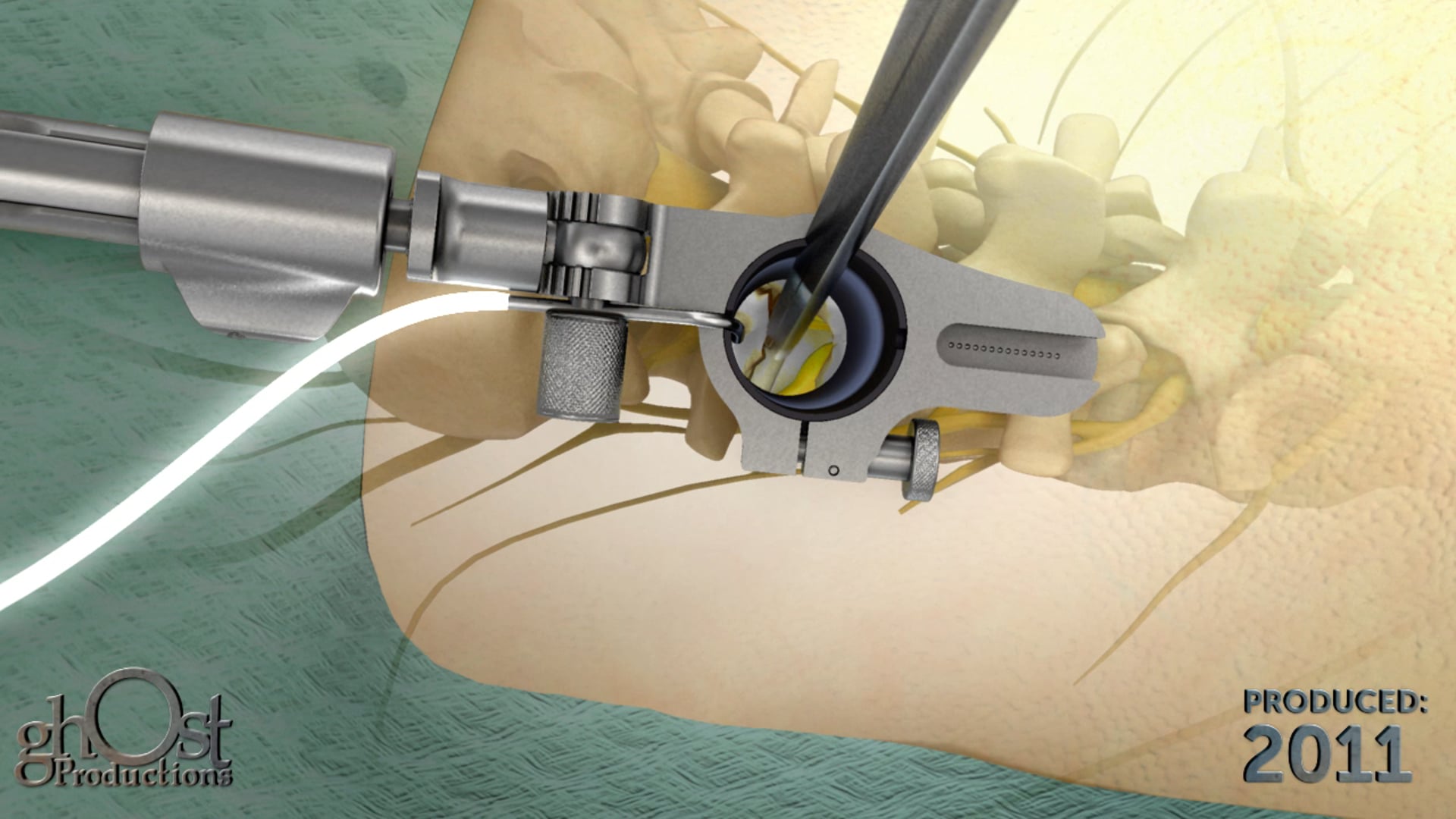 Spineology, AccessPortal device, minimally invasive surgical retractor system, Ghost Productions, neurological risk, decompression, discectomy, posterior lumbar interbody fusion, PLIF, spinal surgery, safer treatment options, effective treatment options.