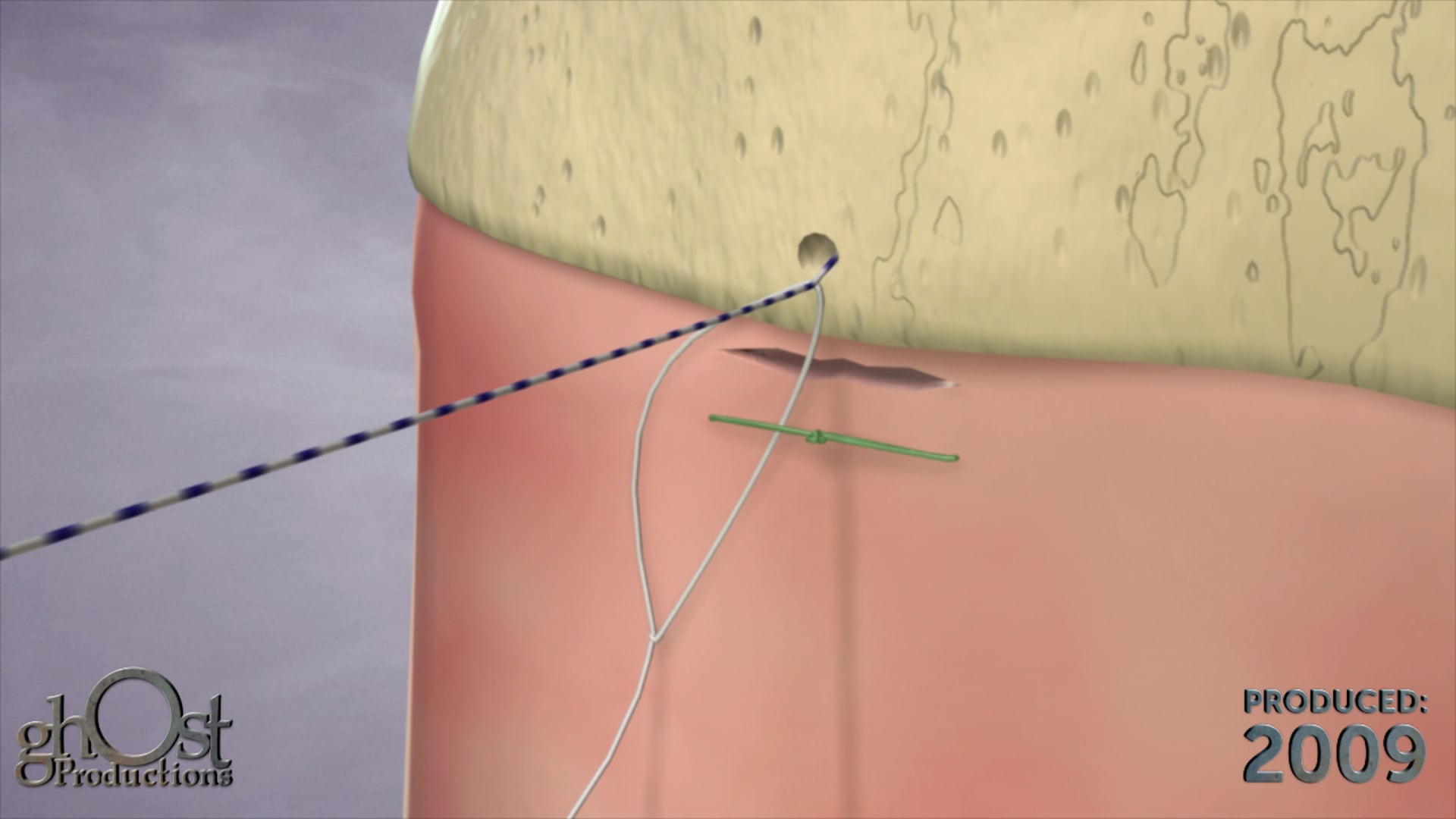 Ghost Medical presents: Anulex RimClose