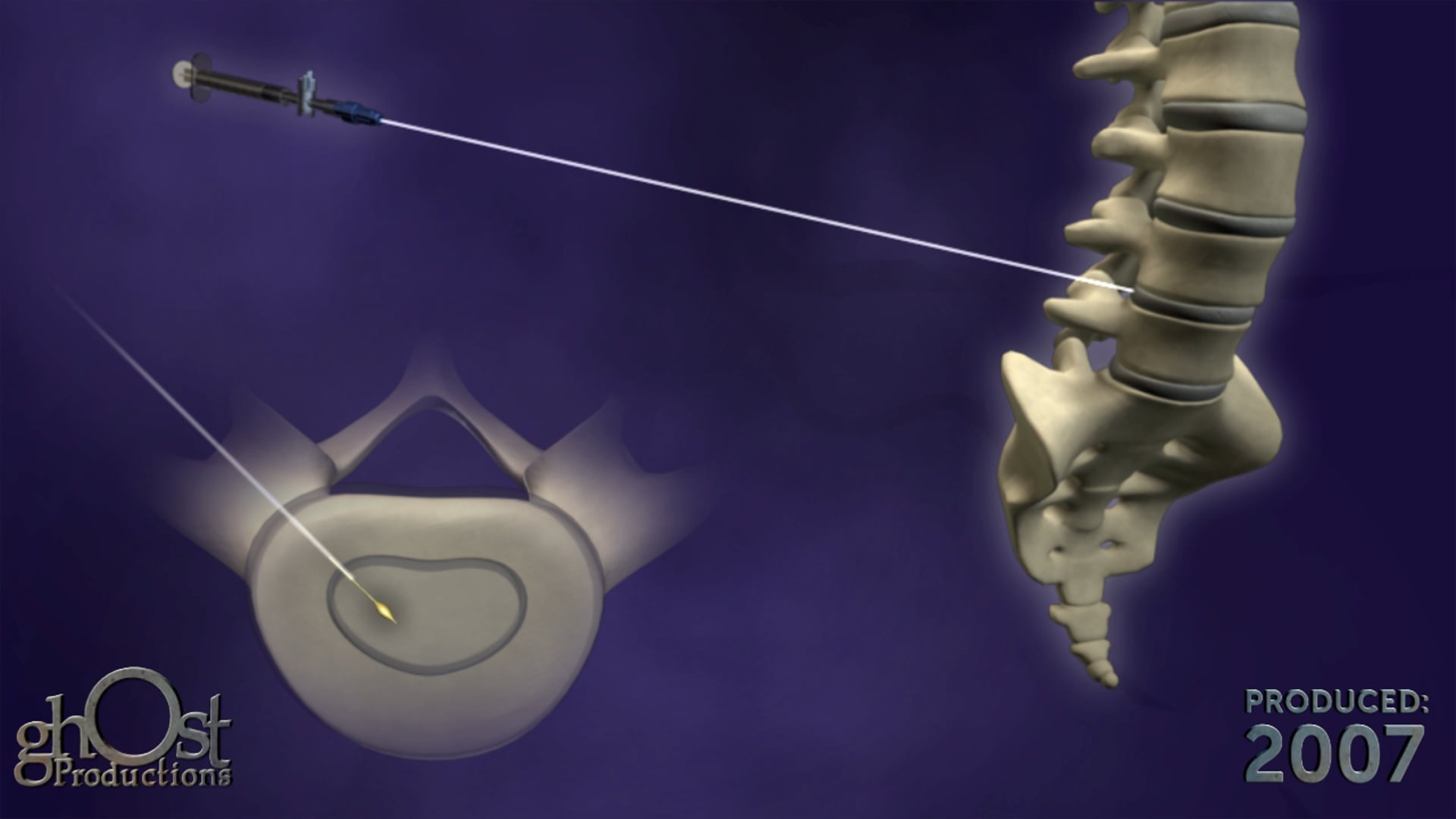 Medtronic, Discyphor device, catheter system, lower back pain, Ghost Productions, animation, clinical evidence, effectiveness, character animation, key features, benefits, healthcare professionals, patients, pain management, medically accurate, innovative product.