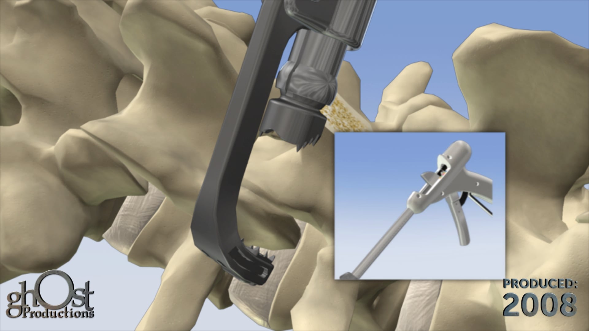 US Spine, medical device company, Ghost Productions, Facet Gun device, chronic back pain, precise injections, medication, advanced targeting system, minimally invasive design, healthcare professionals, patients, spine medicine, medical accuracy, visually stunning, innovative.