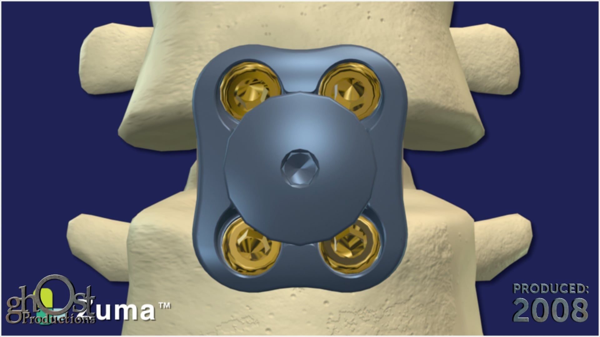 SeaSpine, Zuma device, anterior lumbar interbody device, Ghost Productions, titanium lumbar plate spacer, four screws, locking cover, maximum stability, spinal surgery, lumbar interbody procedures, expert animation, medical professionals, patients, unique features, benefits.