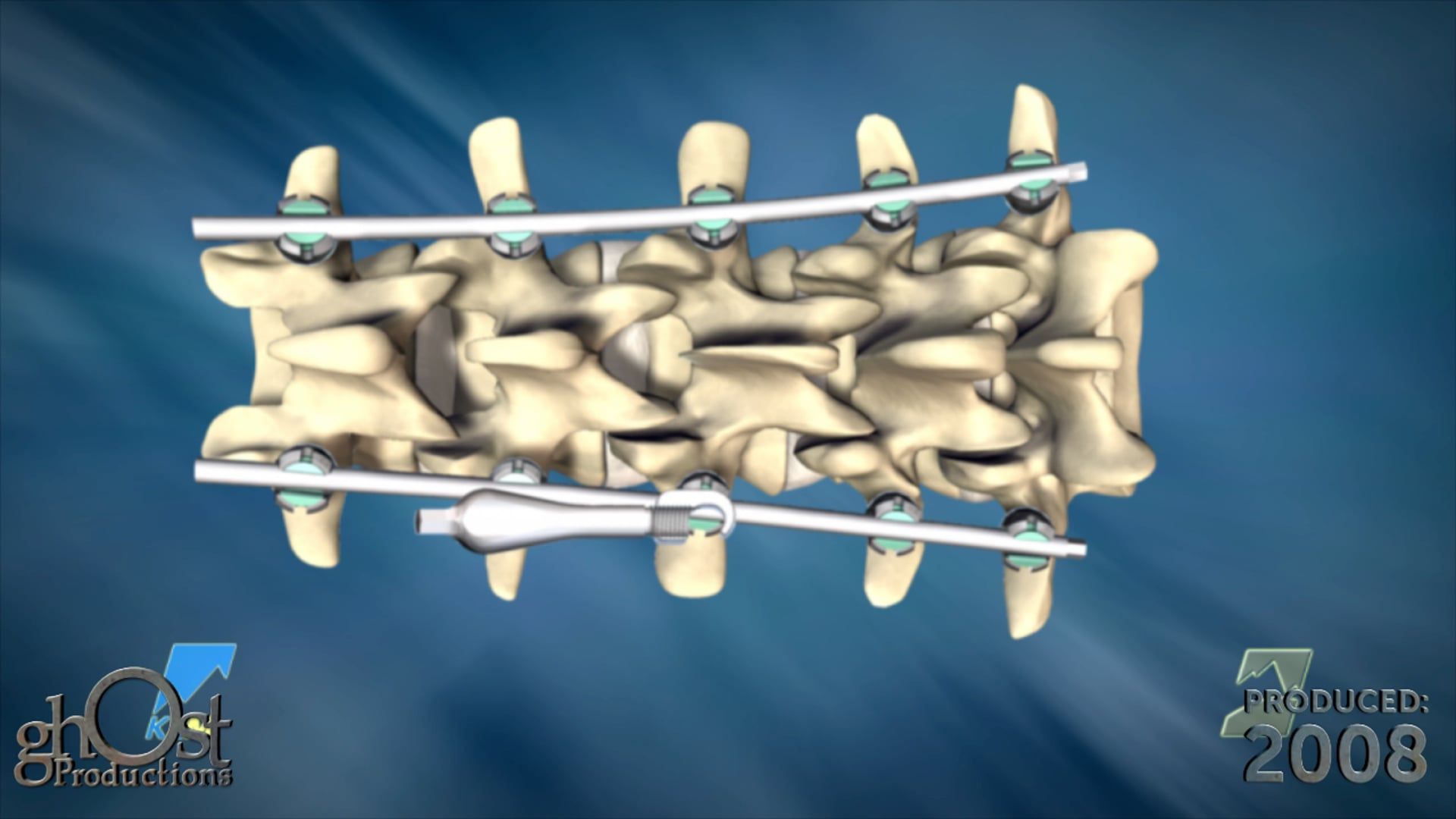 K2M, Ghost Productions, Range Complex Spine Technology, thoracolumbar device, spinal pathologies, Thoracolumbar Spinal Deformity, surgical technique, lumbar vertebrae, procedure, medically accurate video, healthcare professionals, cutting-edge spinal technology.