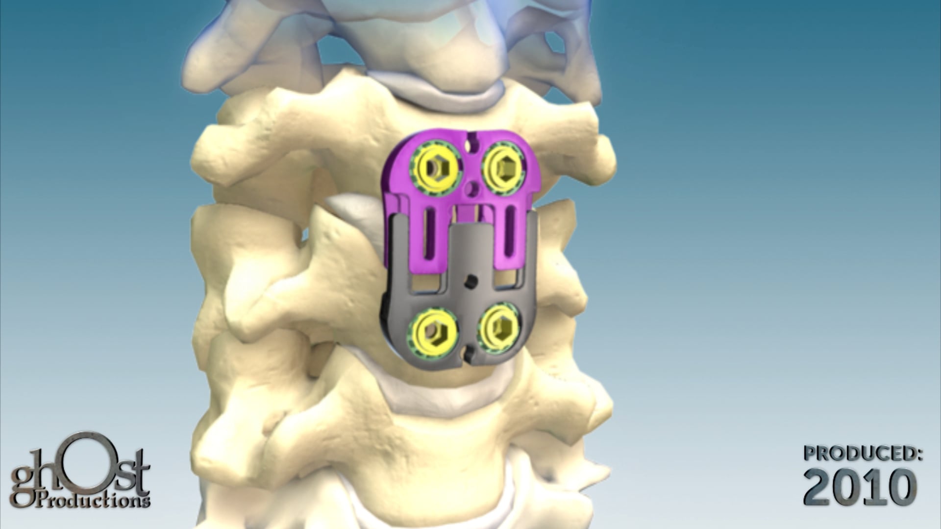 Zimmer Spine, Ghost Productions, Ant-Cer II device, anterior cervical plating device, fusion, implant interference, healthy disc space, superior outcomes, cervical spine surgery, healthcare professionals, patient outcomes.