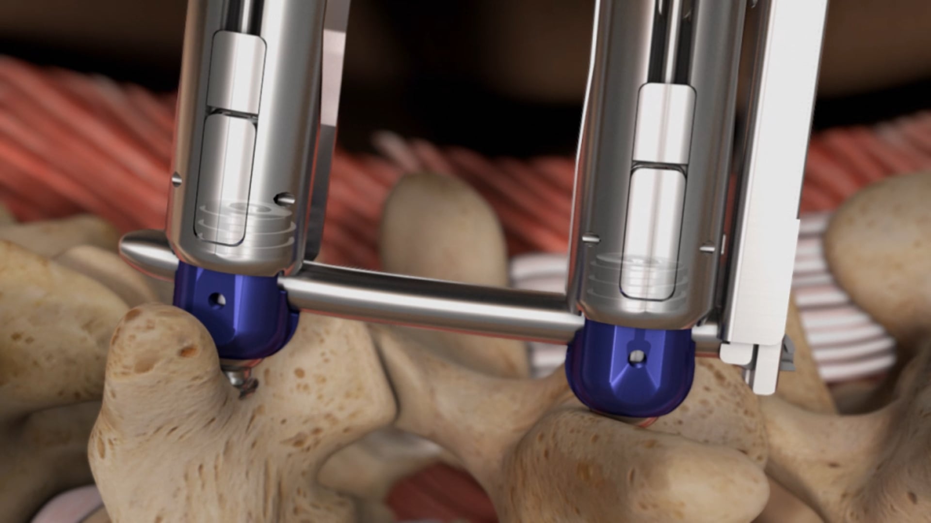 Ghost Productions, medical animation studio, Spineology, Threshold Pedicular Fixation device, secure implant-to-instrumentation connections, unique screw design, advanced articulating rod placement, muscle entrapment, breakthrough in spinal surgery, animation, features, benefits, surgical VR development services, medical devices, pharmaceutical products.