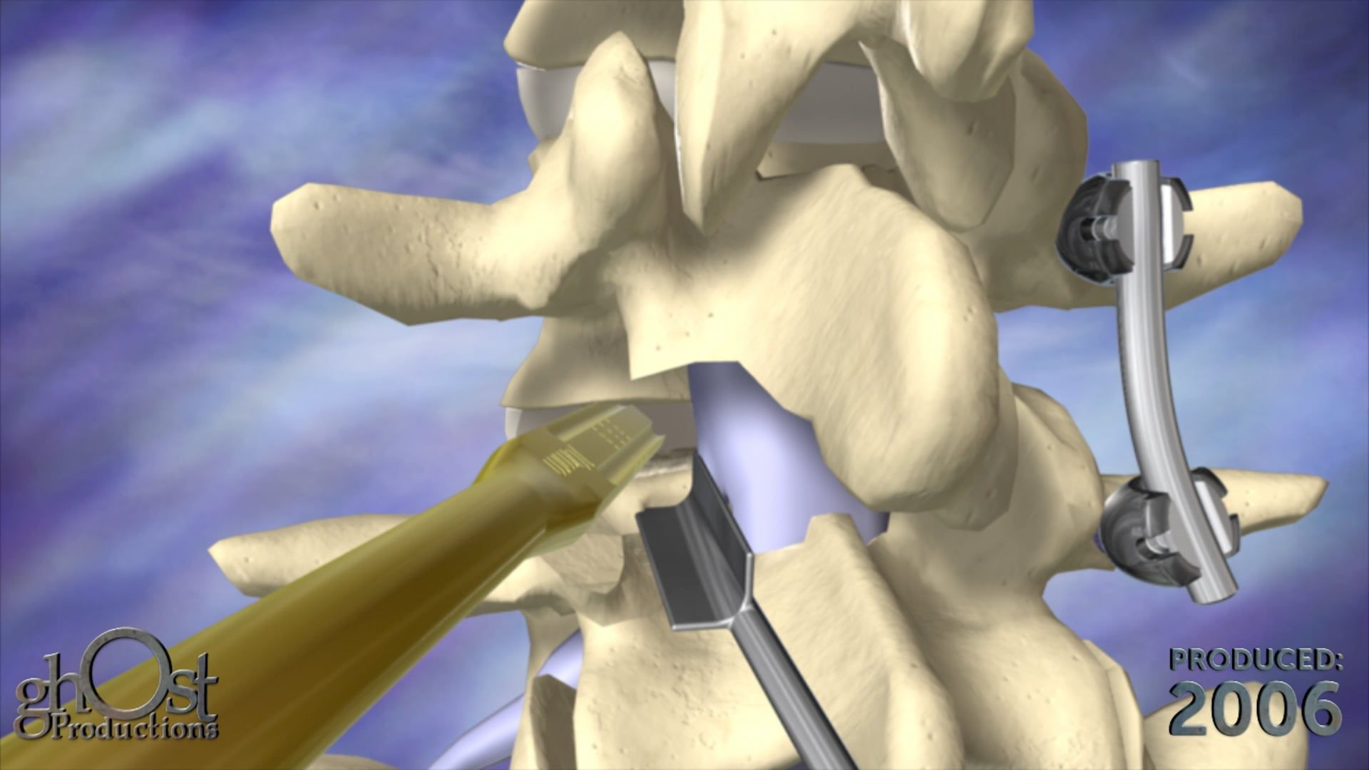 medical animation, Transforaminal Lumbar Interbody Fusion, TLIF surgery, K2M, innovative tools, devices, sagittal alignment, interbody spacer, pedicle screws, rods, posterior stabilization, anterior stabilization, medical professionals, intricacies, benefits.