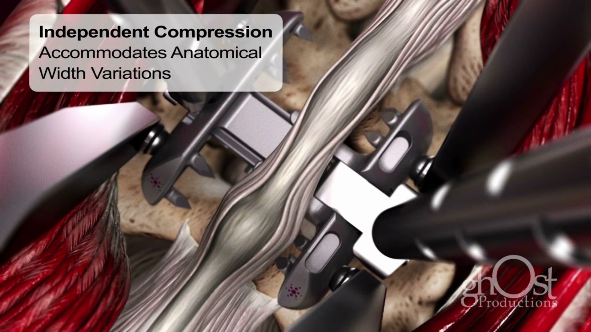 Ghost Productions, Inc., Spineology, VIA spinous process fixation device, animation, posterior spinal anatomy, adjustable width clamping anchors, interspinous ligament, supraspinous ligament, spinal surgery.