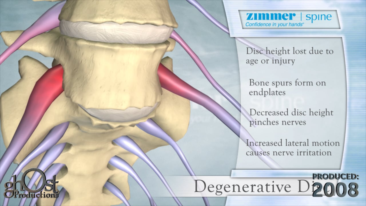 Zimmer Spine, Ghost Productions, medical device company, informative animation, nerve irritation, pain, degenerative disc disease, medically accurate depiction, degenerative process, spinal discs, compression of nerves, educational tool, healthcare professionals, patients, underlying mechanisms, common condition, advancing the field, spinal medicine, partnership, innovative educational animation.