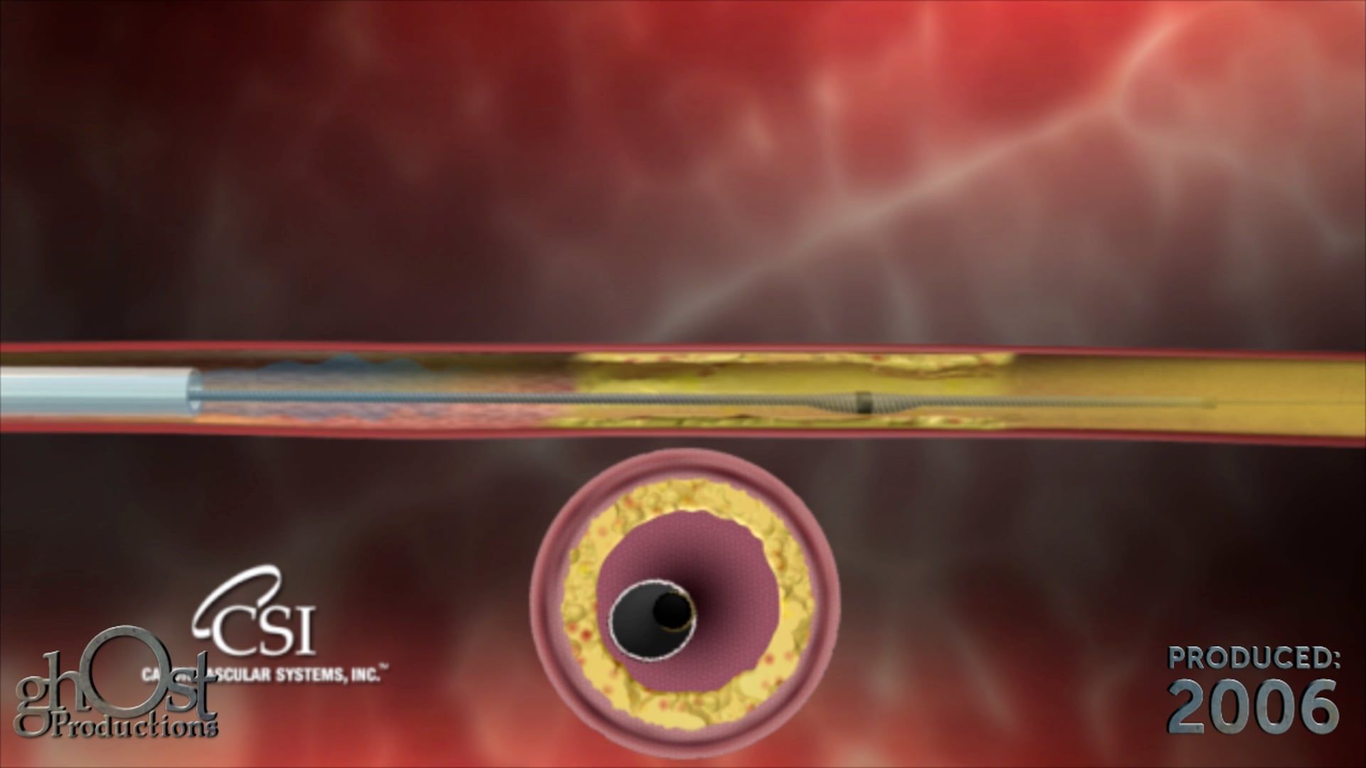 Healthcare Academy, Ghost Productions, CSI Orbital Atherectomy Device, peripheral artery disease, medical device, minimally invasive solution, hard plaque buildup, artery, innovative technology, medical accuracy, healthcare professionals, patients, vascular medicine, informative video, benefits, revolutionize.