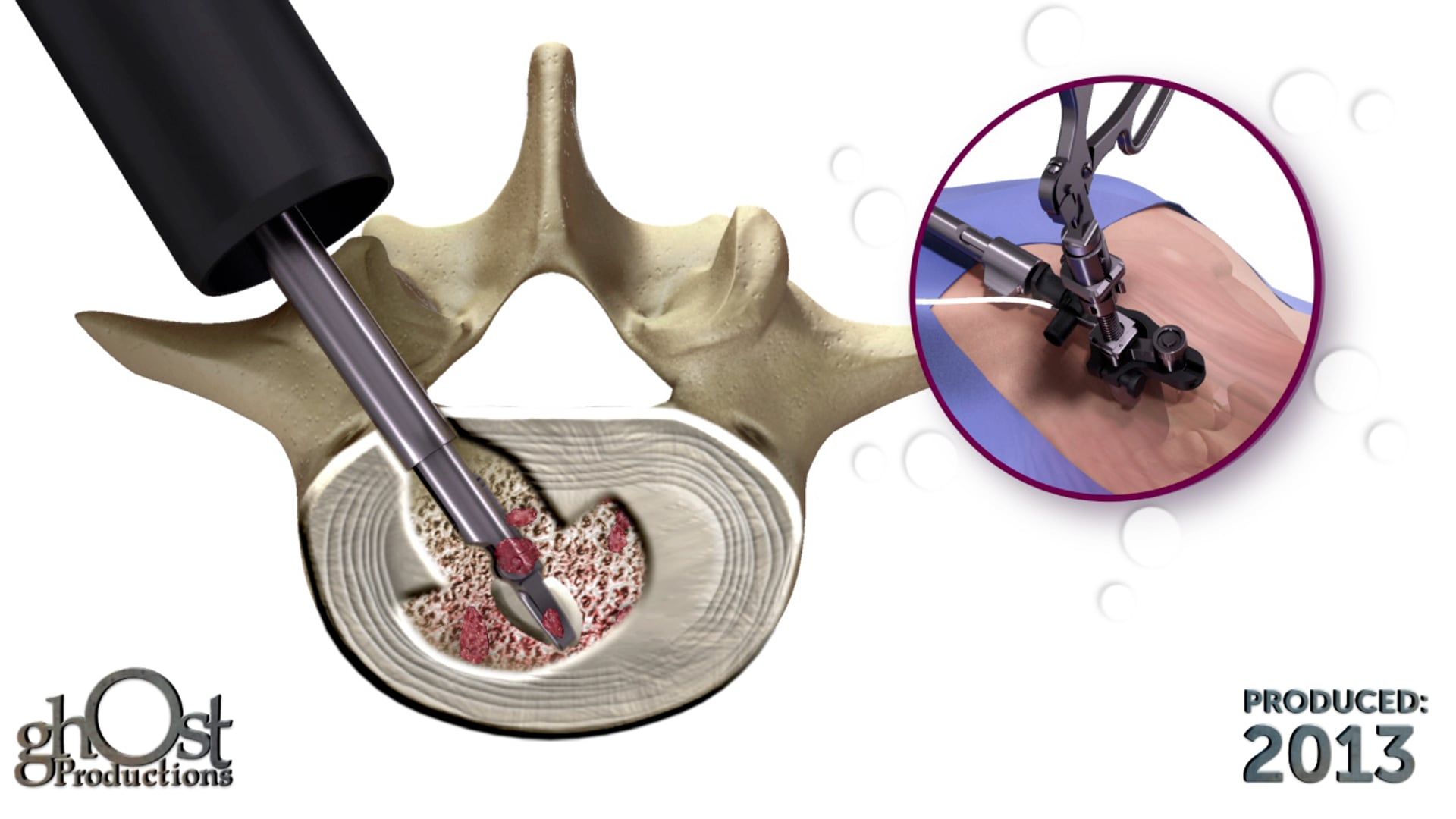 Spineology, SOAR device, Ghost Productions, animation, retractor system, surgical outcomes, neural retraction, articulating discectomy instruments, tubular tissue retractor system, visualization, neurologic risk, spinal surgeries, unique features, revolutionize, spinal surgery, medical professionals, patients, cutting-edge technology, improve patient outcomes, reduce risk of complications.