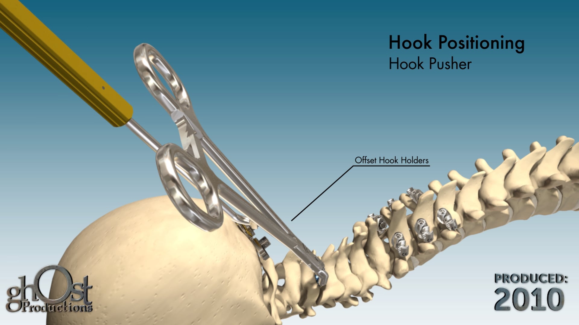 Zimmer Spine, Ghost Productions, Nex-Link OCT, occipito-cervical spinal fixation system, medical device, stability, injury, instability, animation, medical accuracy, unique features, benefits, spinal medicine, medical professionals, patients.