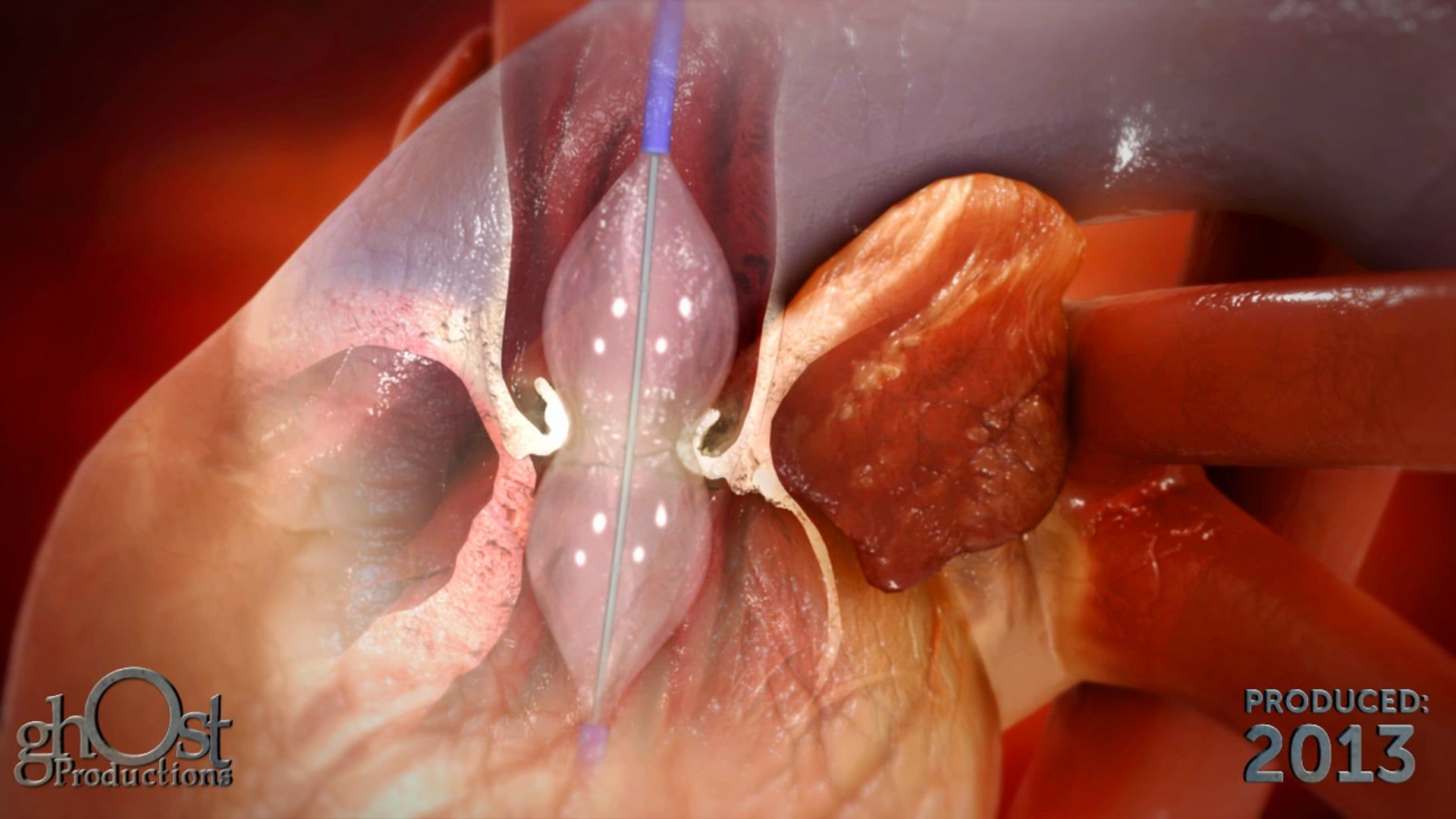 InterValve, Ghost Productions, medical device animation, V8 device, catheter, aortic valvuloplasty, figure 8-shaped balloon, breakthrough, cardiology, medically accurate representation, features, benefits, medical professionals, patients, advancements.