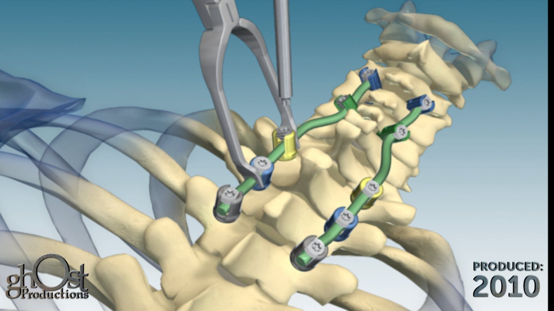 Zimmer Spine, Ghost Productions, Nex-Link system, posterior cervicothoracic spinal fixation, upper spine trauma, degeneration, adjustable occipital plate, midline fixation, pre-contoured rods, stability, support, spinal surgery, medical professionals, patients, animation, informative, innovative technology, comprehensive solution.